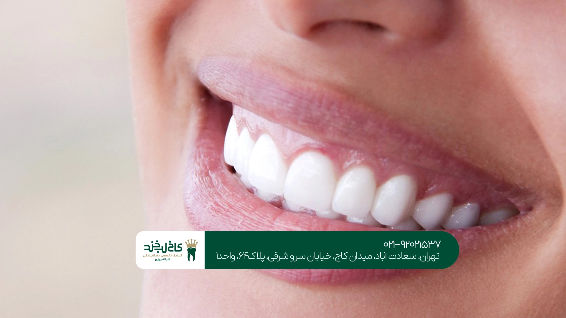 هزینه زیبایی دندان در تهران چقدر است؟