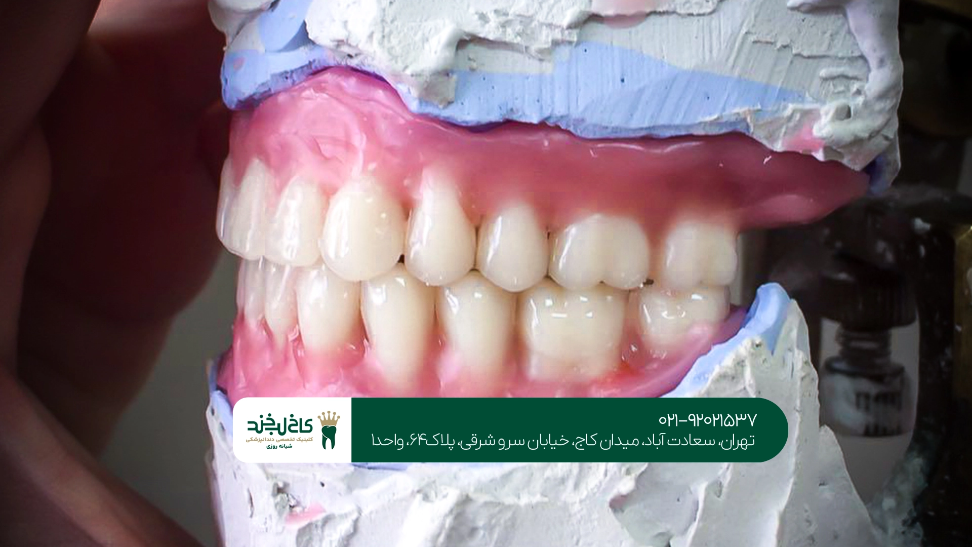 ساخت دندان مصنوعی در تهران