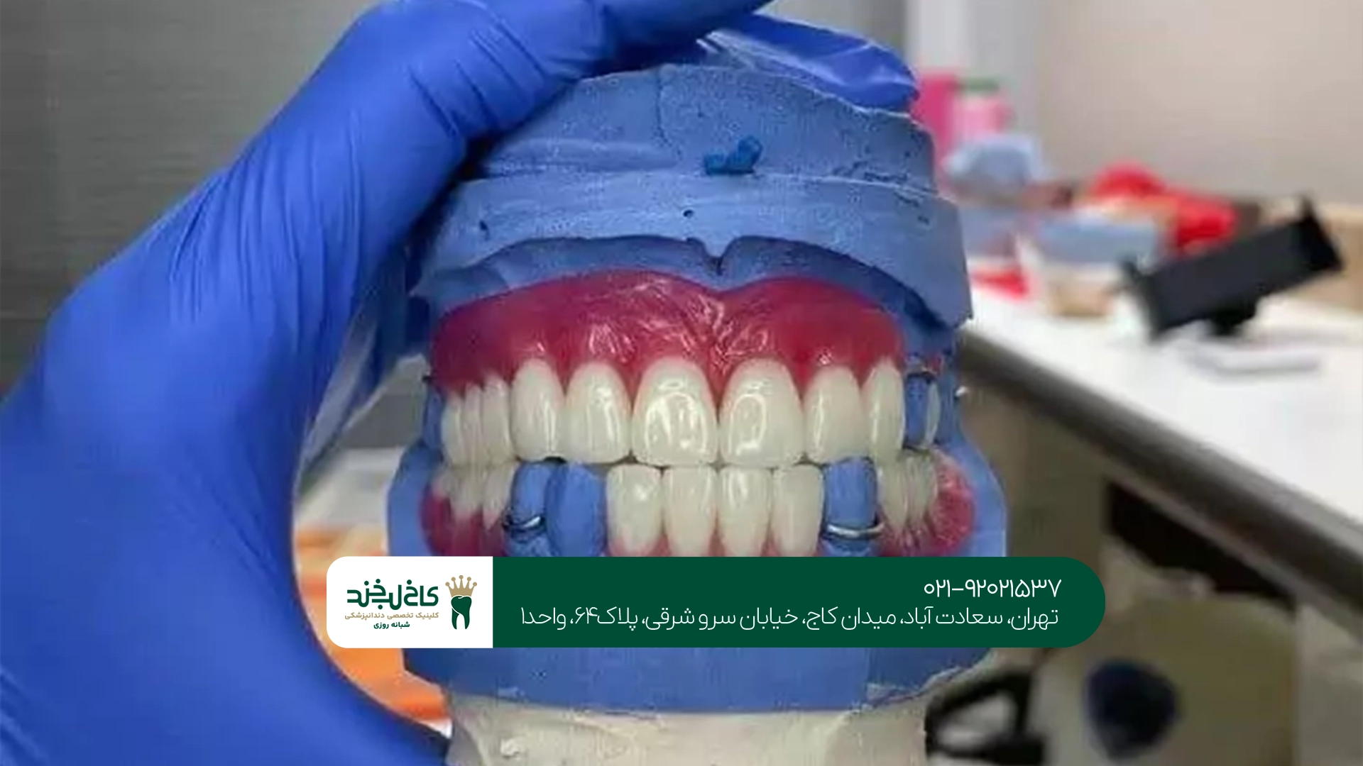 دندان مصنوعی چقدر دوام دارد؟
