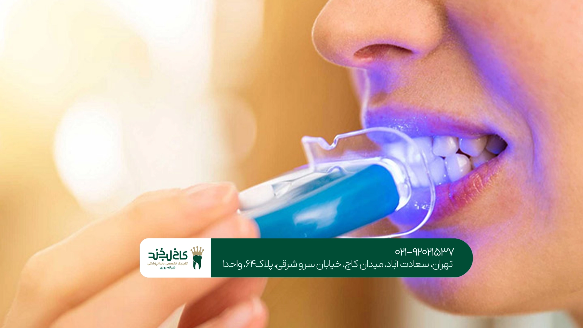 بلیچینگ دندان با دستگاه لیزر