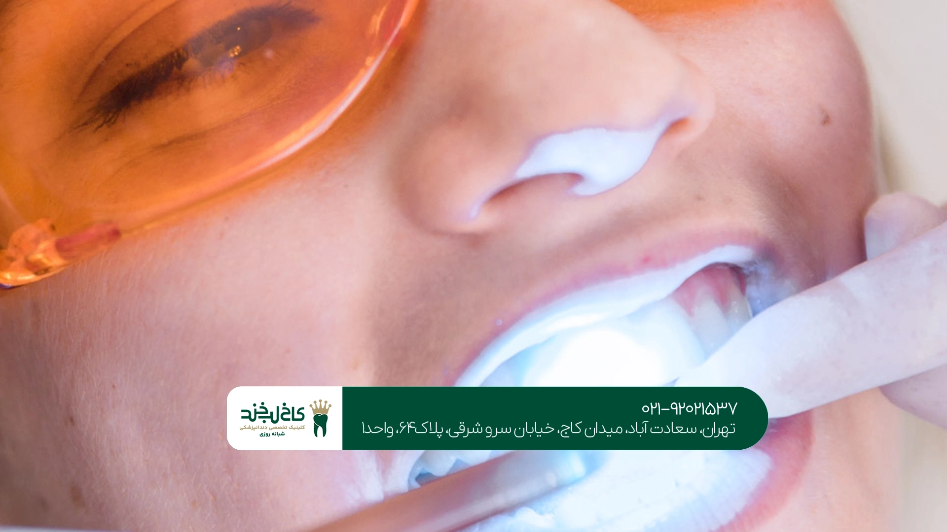 بلیچینگ لیزری در تهران