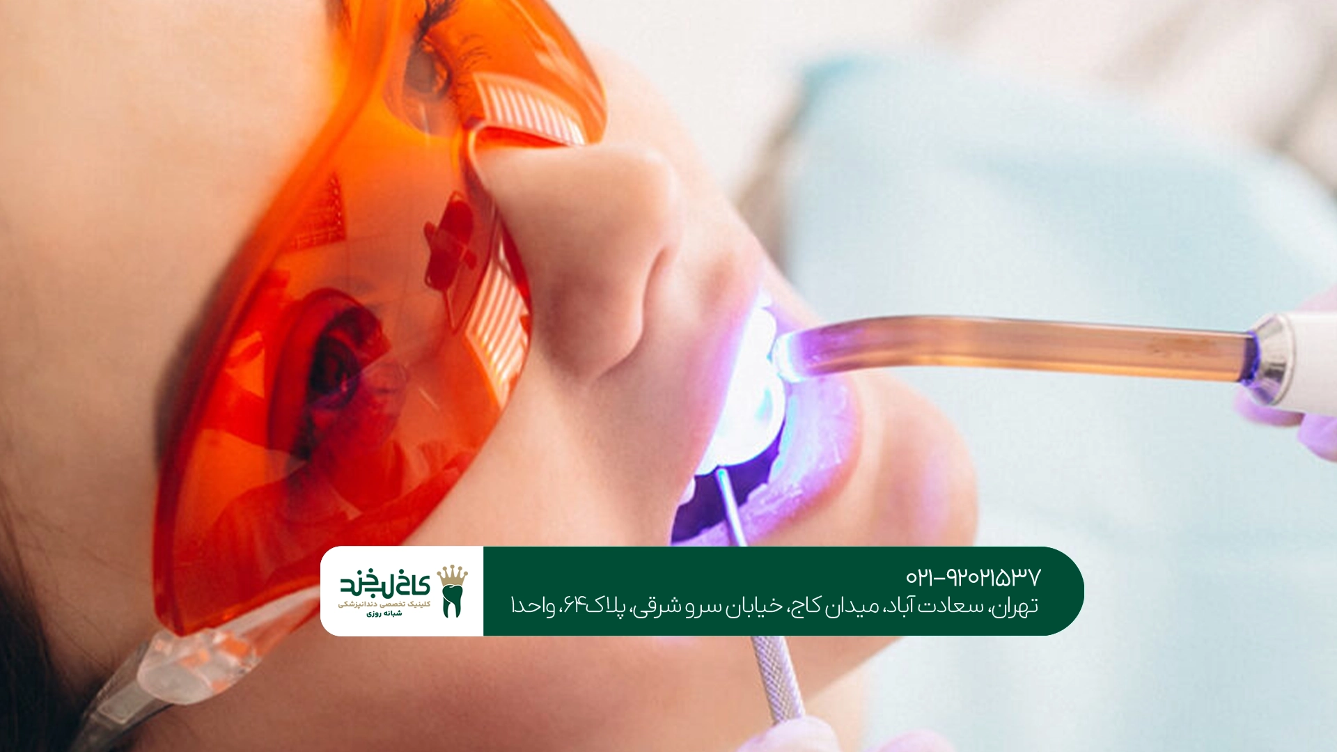 سفید کردن دندان با لیزر چقدر ماندگاری دارد؟