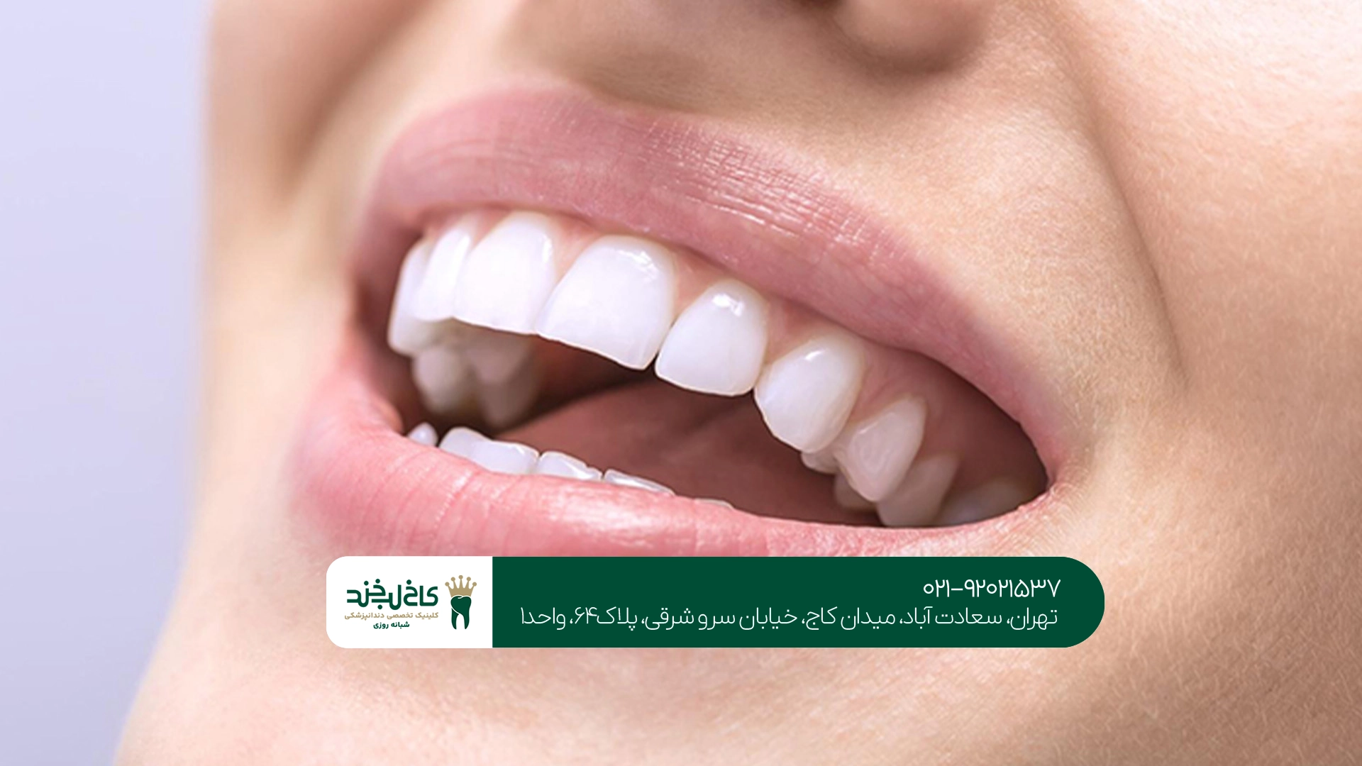 سفید کردن دندان سفید کردن دندان