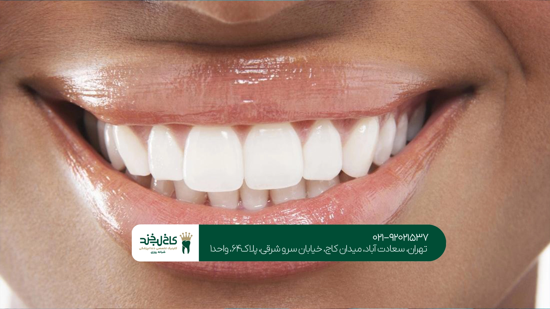 بلیچینگ سریع دندان بلیچینگ سریع دندان