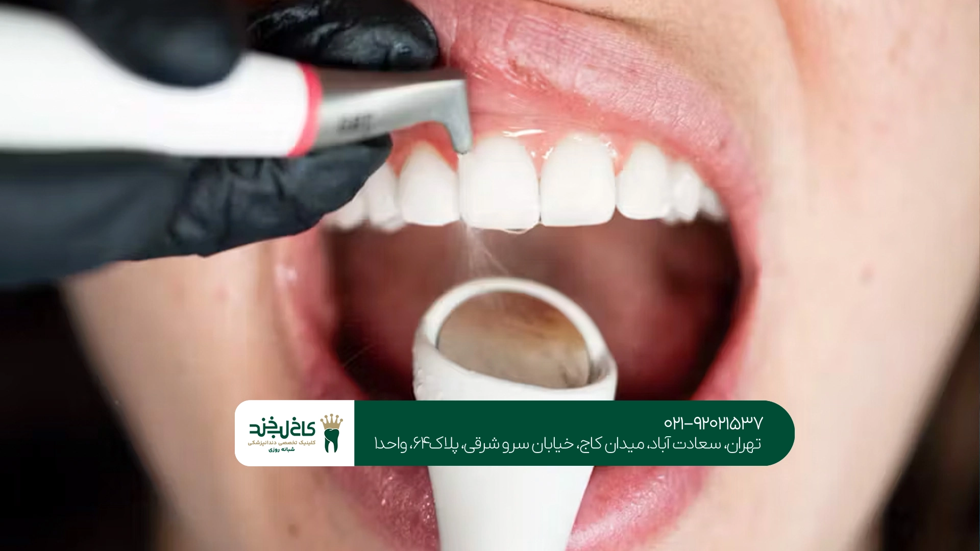 بهترین مرکز سفید کردن دندان بهترین مرکز سفید کردن دندان