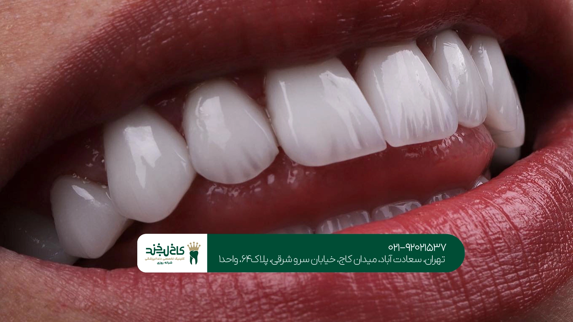 بهترین کلینیک لمینت دندان