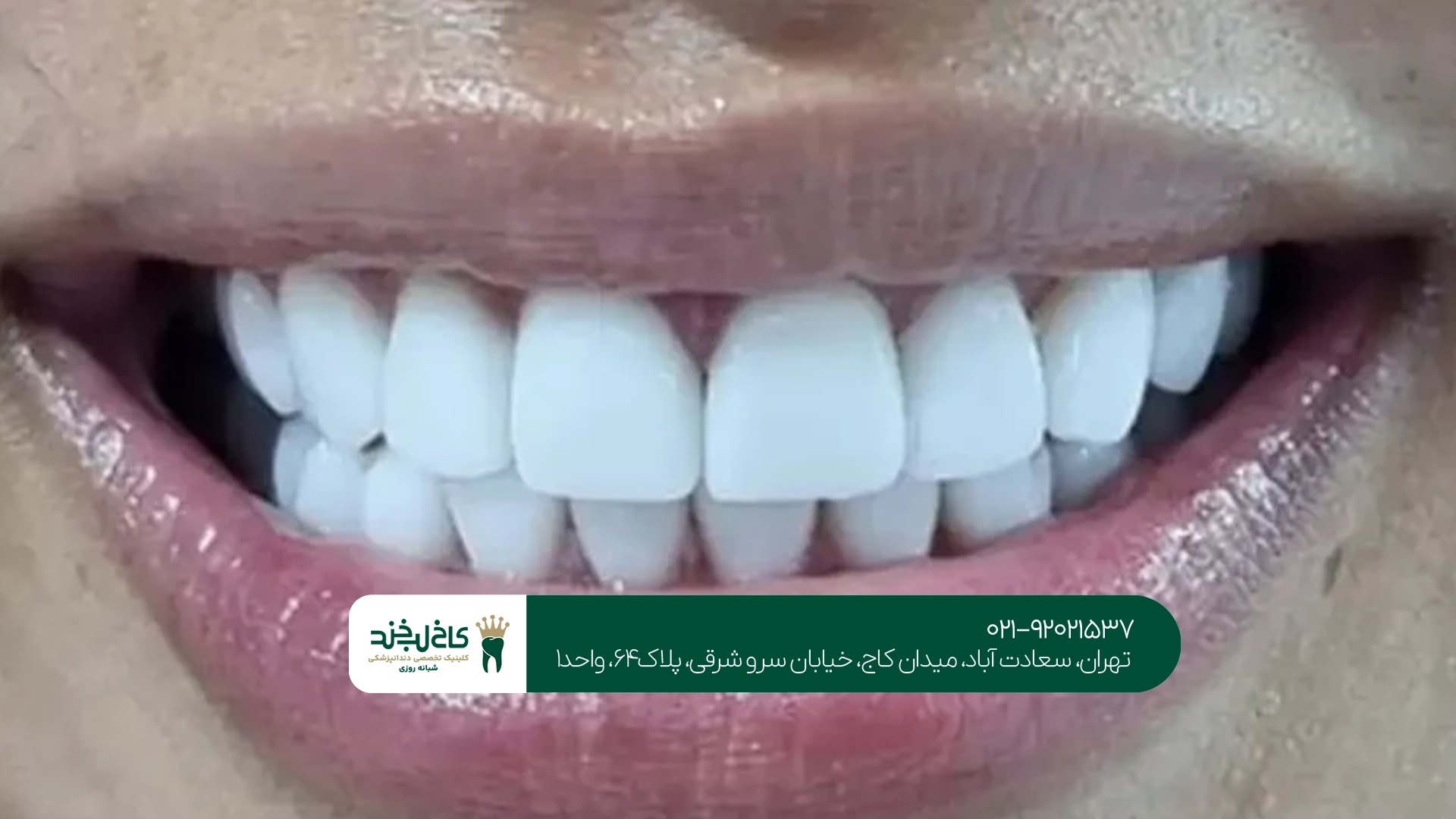 لمینت دندان طبیعی برای طرح لبخند