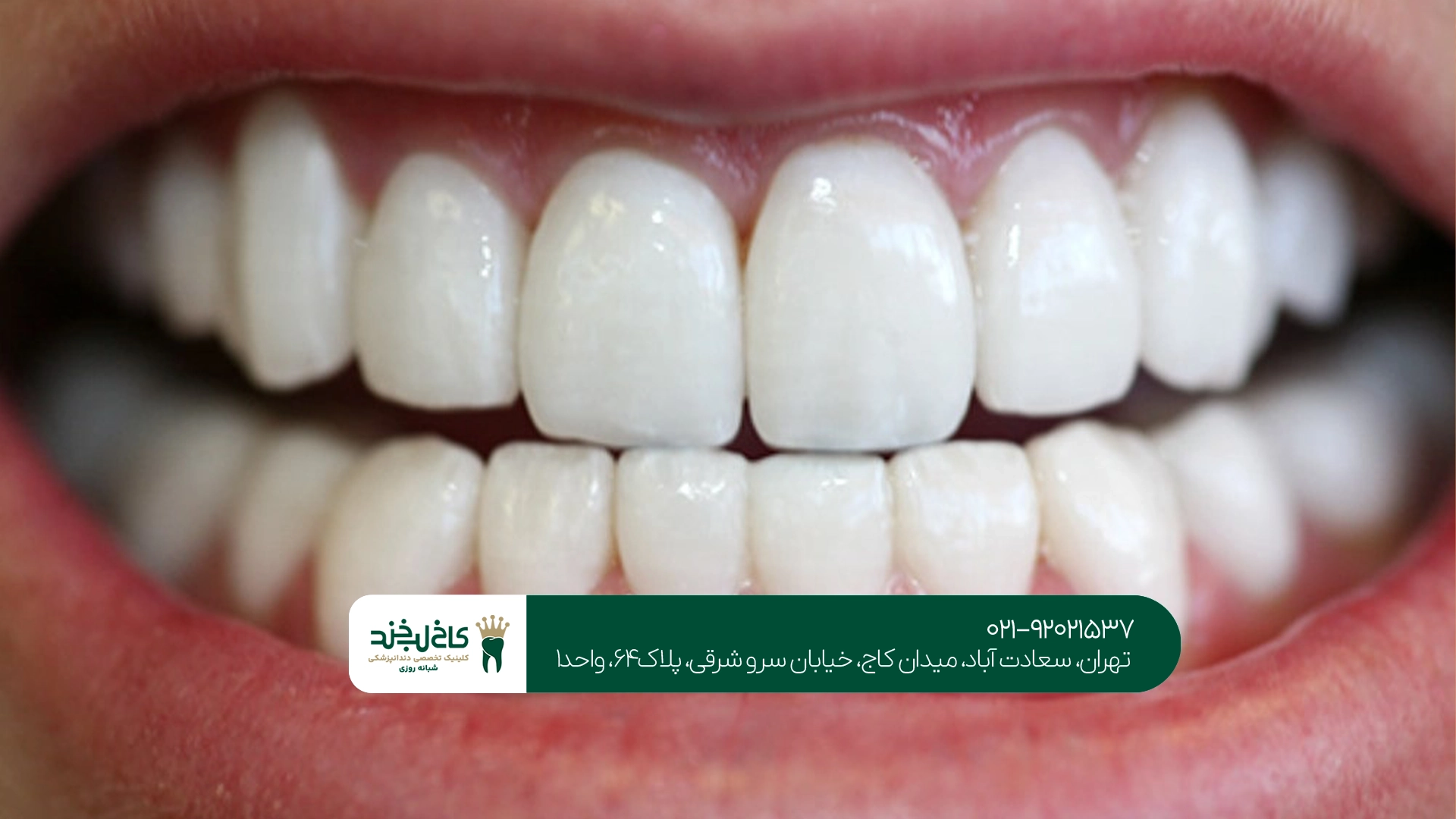کامپوزیت ونیر برای طراحی لبخند