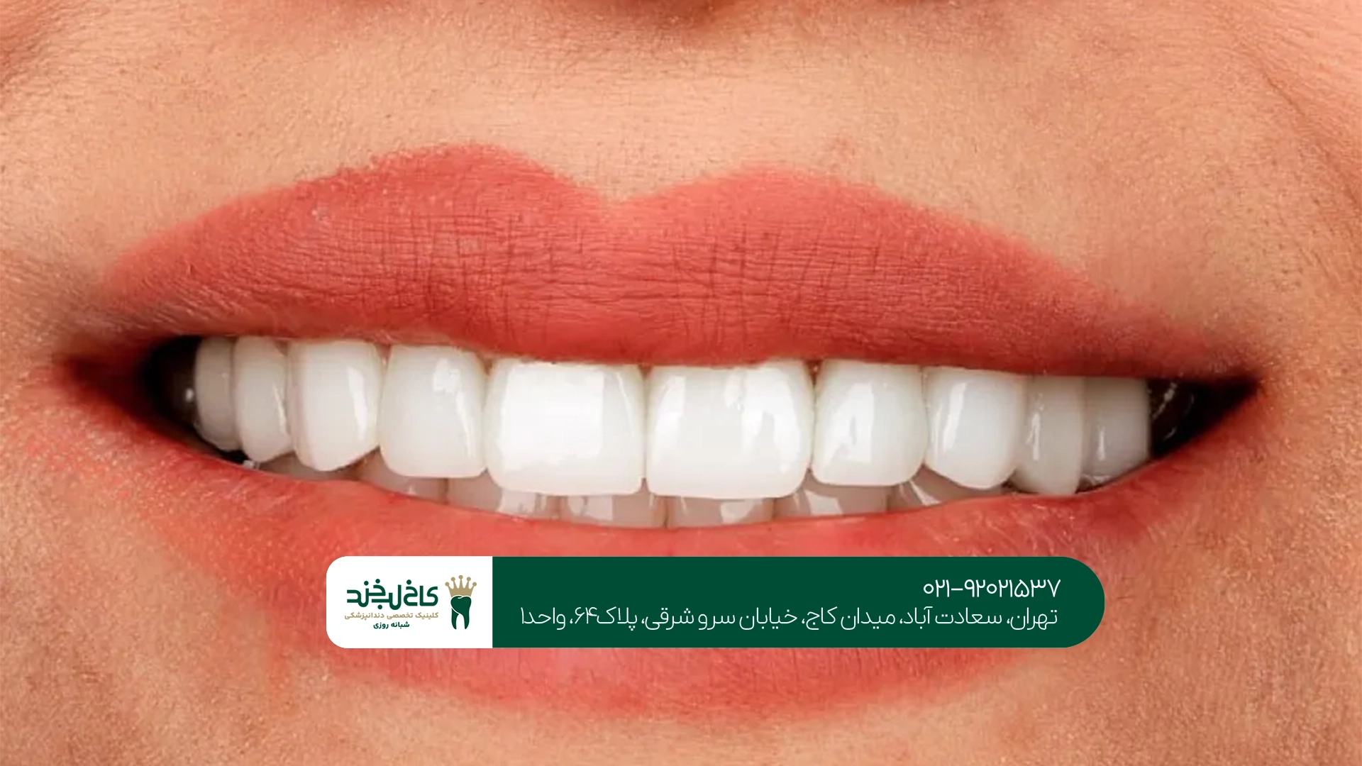 هزینه اصلاح طرح لبخند با کامپوزیت
