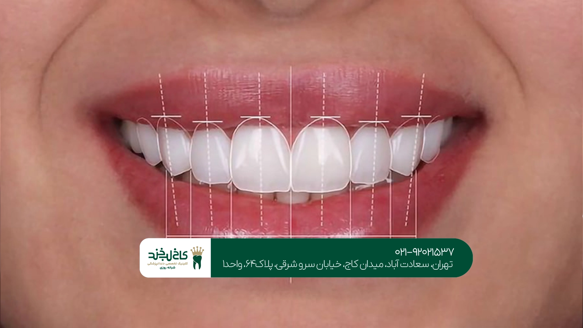کاخ لبخند طراحی لبخند