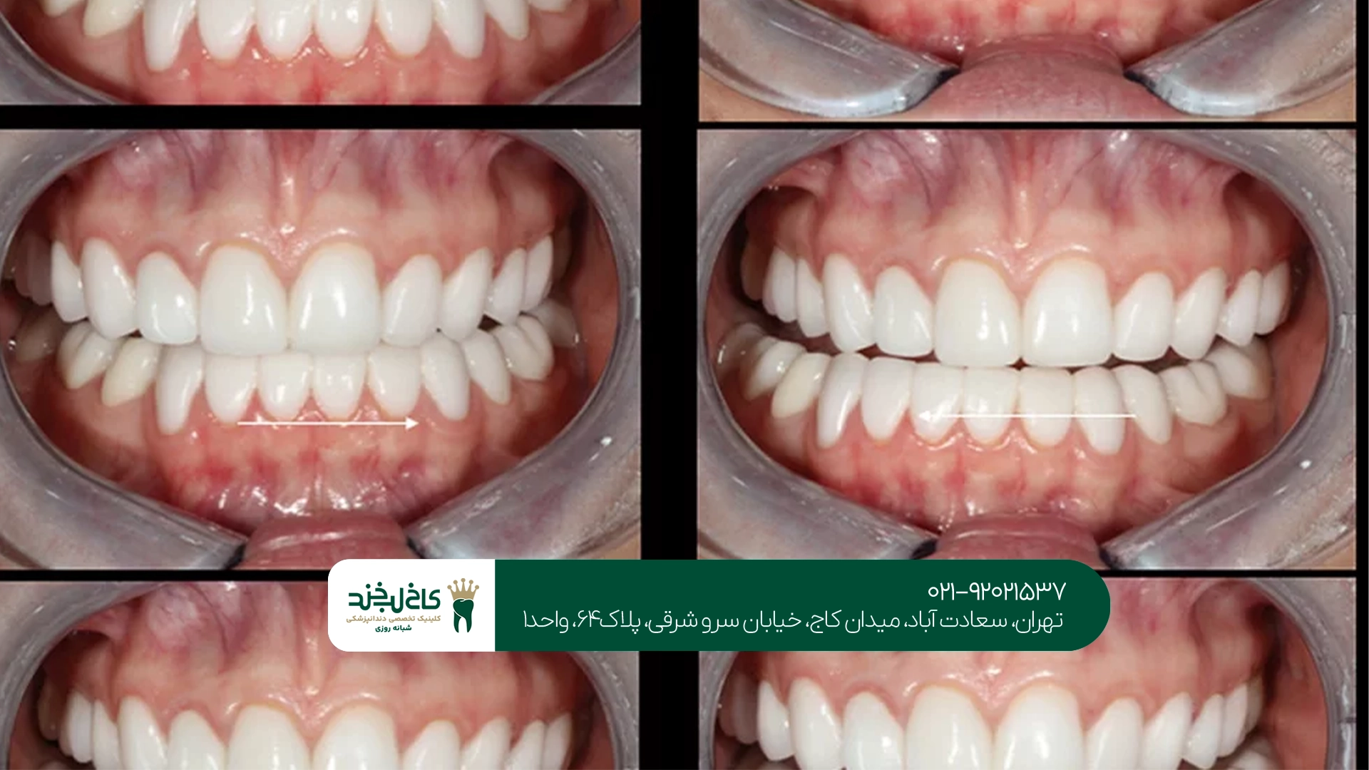 بهترین طراحی لبخند