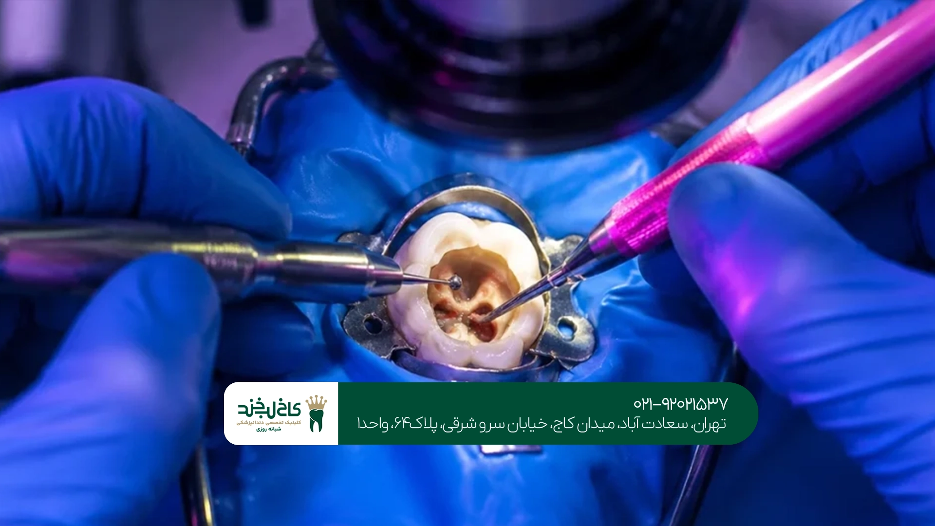 عصب کشی دندان در تهران