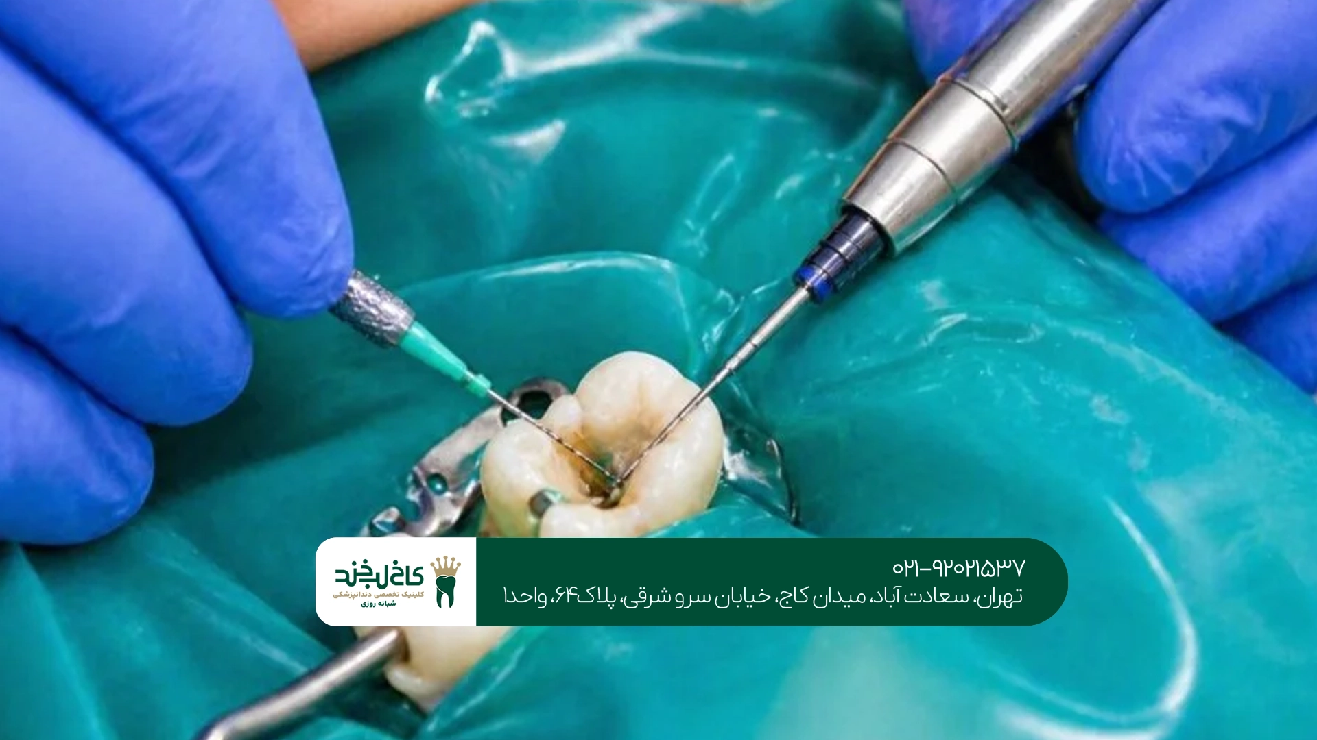 بهترین کلینیک عصب کشی دندان