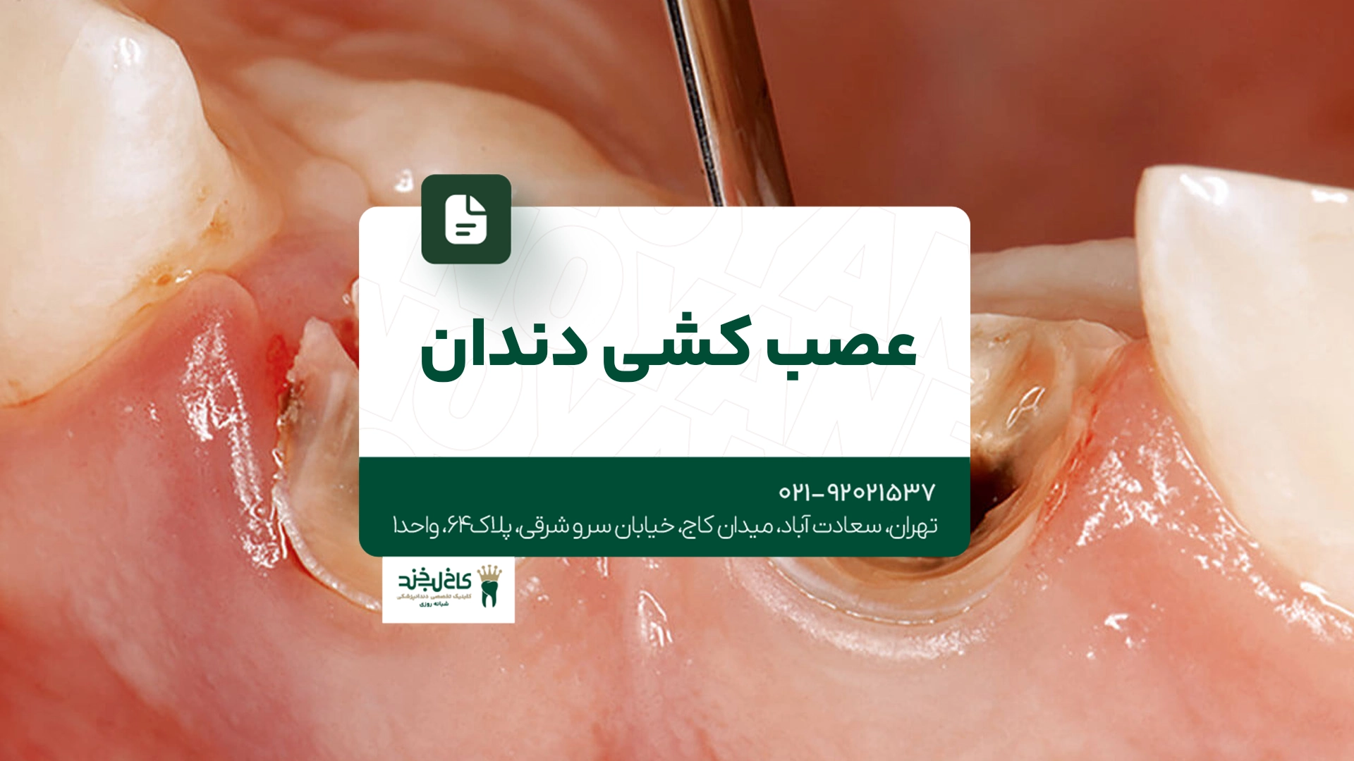 عصب کشی دندان