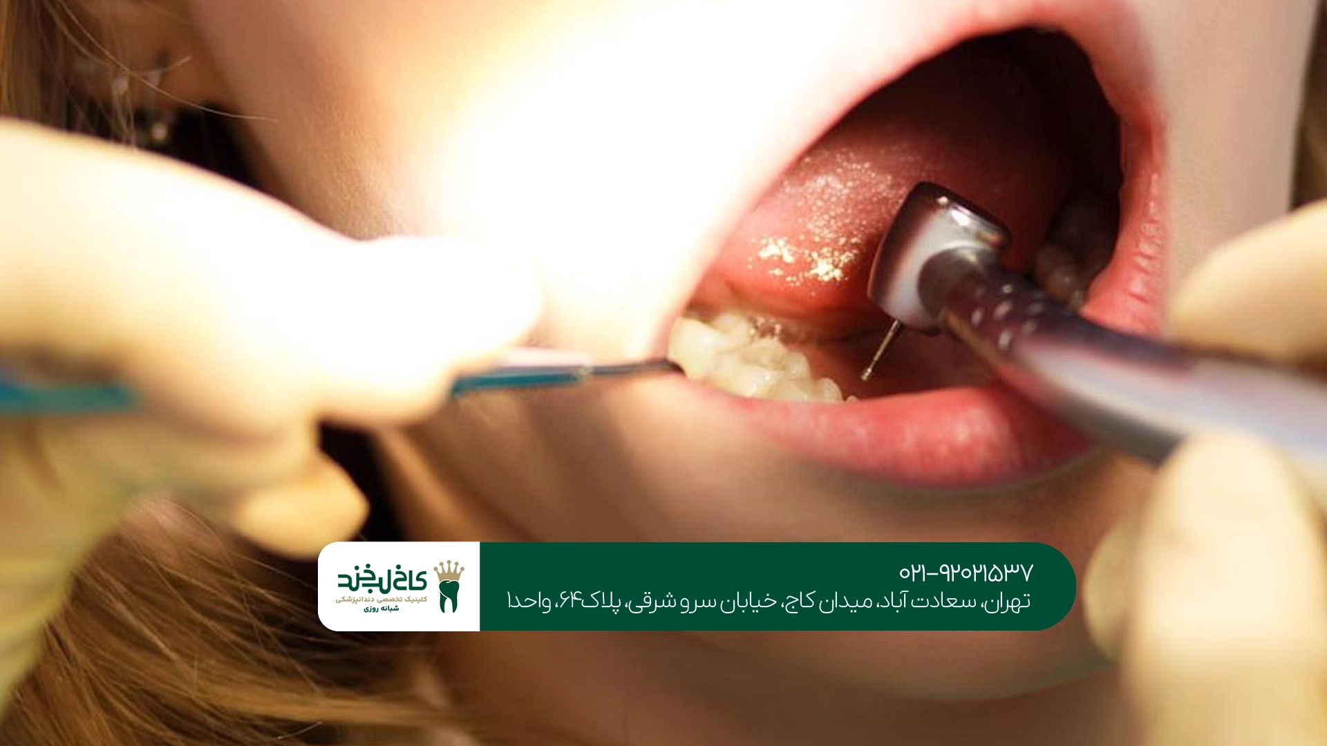 تفاوت عصب کشی و پر کردن دندان چیست؟