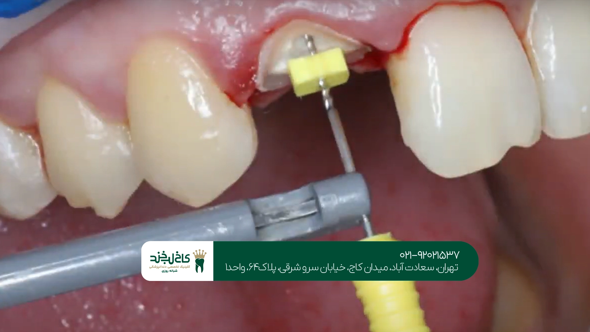 چه عواملی باعث نیاز به عصبکشی دندان میشوند؟ چه عواملی باعث نیاز به عصبکشی دندان میشوند؟