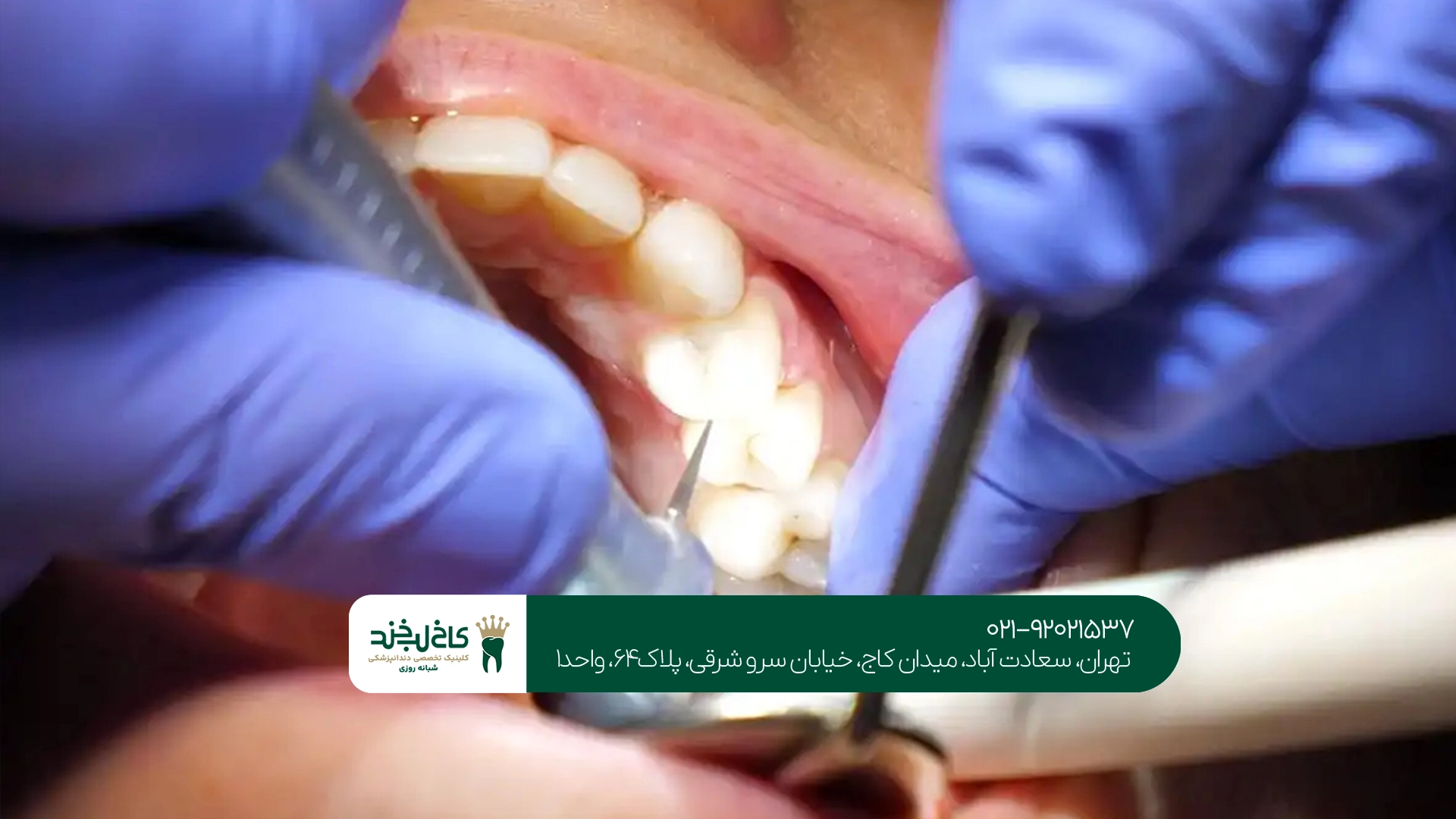 خدمات تخصصی عصب کشی دندان
