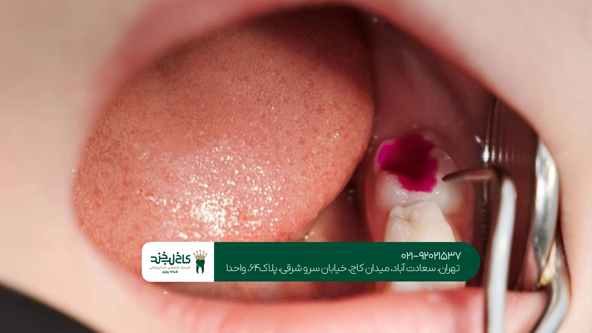 بهترین مرکز عصب کشی دندان