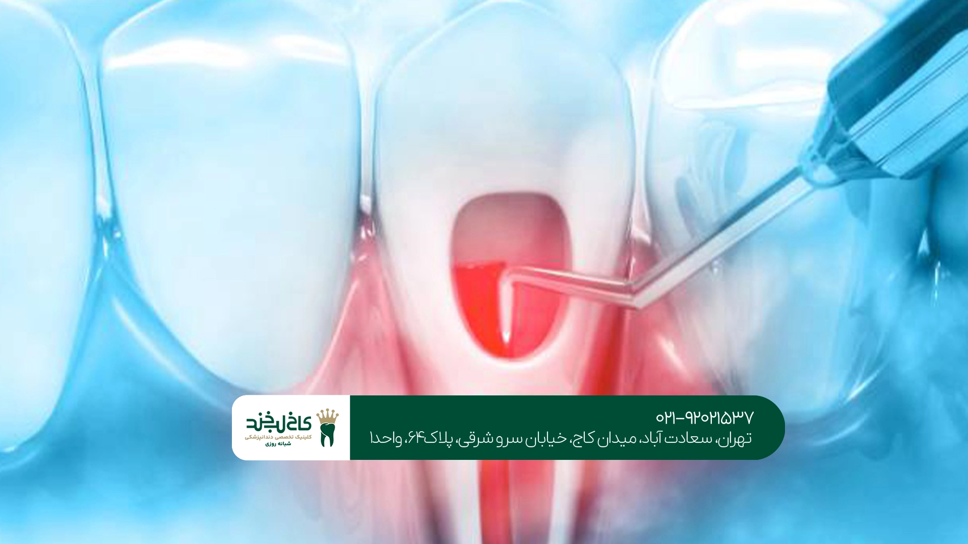 عصب کشی دندان چقدر درد دارد؟