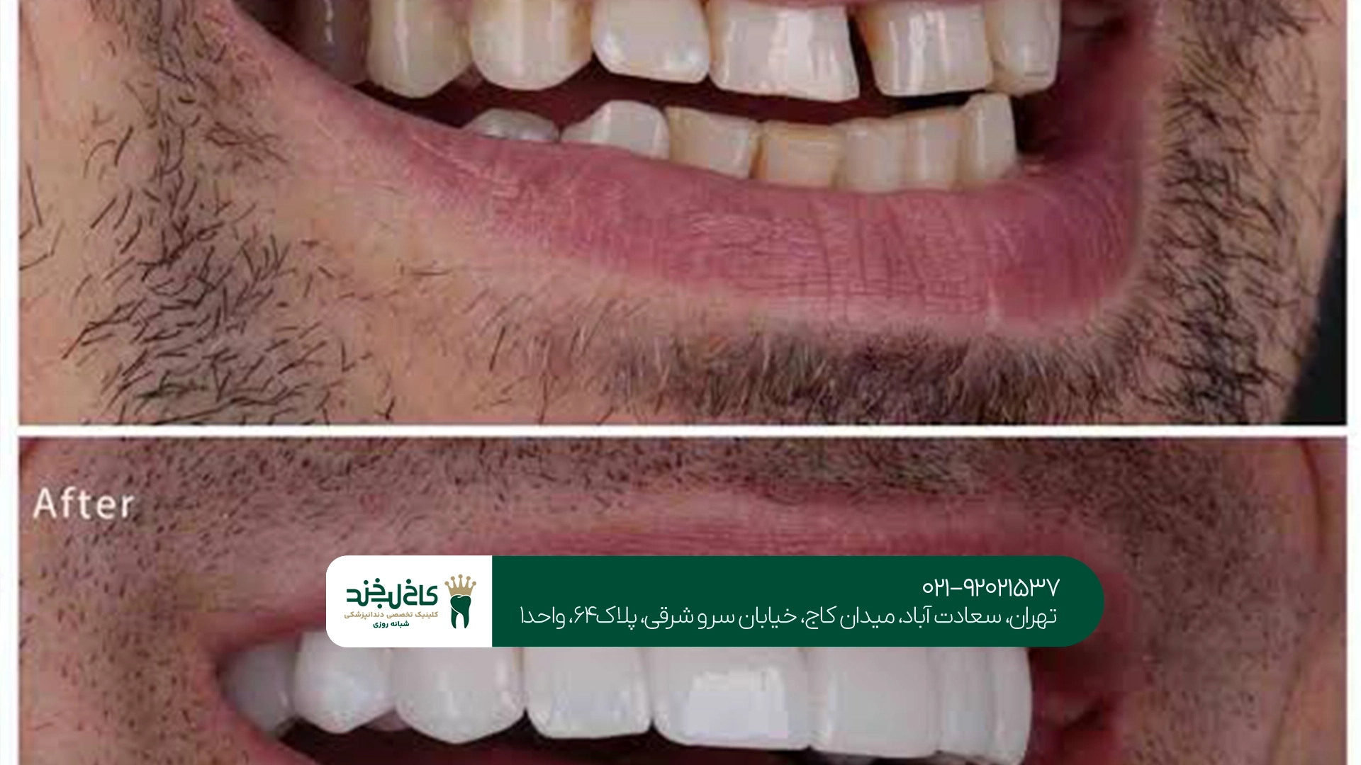 بهترین مرکز بستن فاصله دندان بهترین مرکز بستن فاصله دندان
