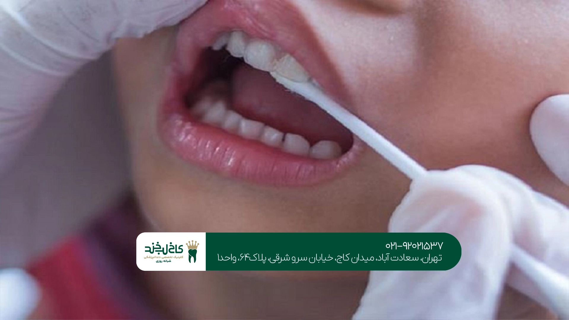 مزایای فلوراید تراپی مزایای فلوراید تراپی
