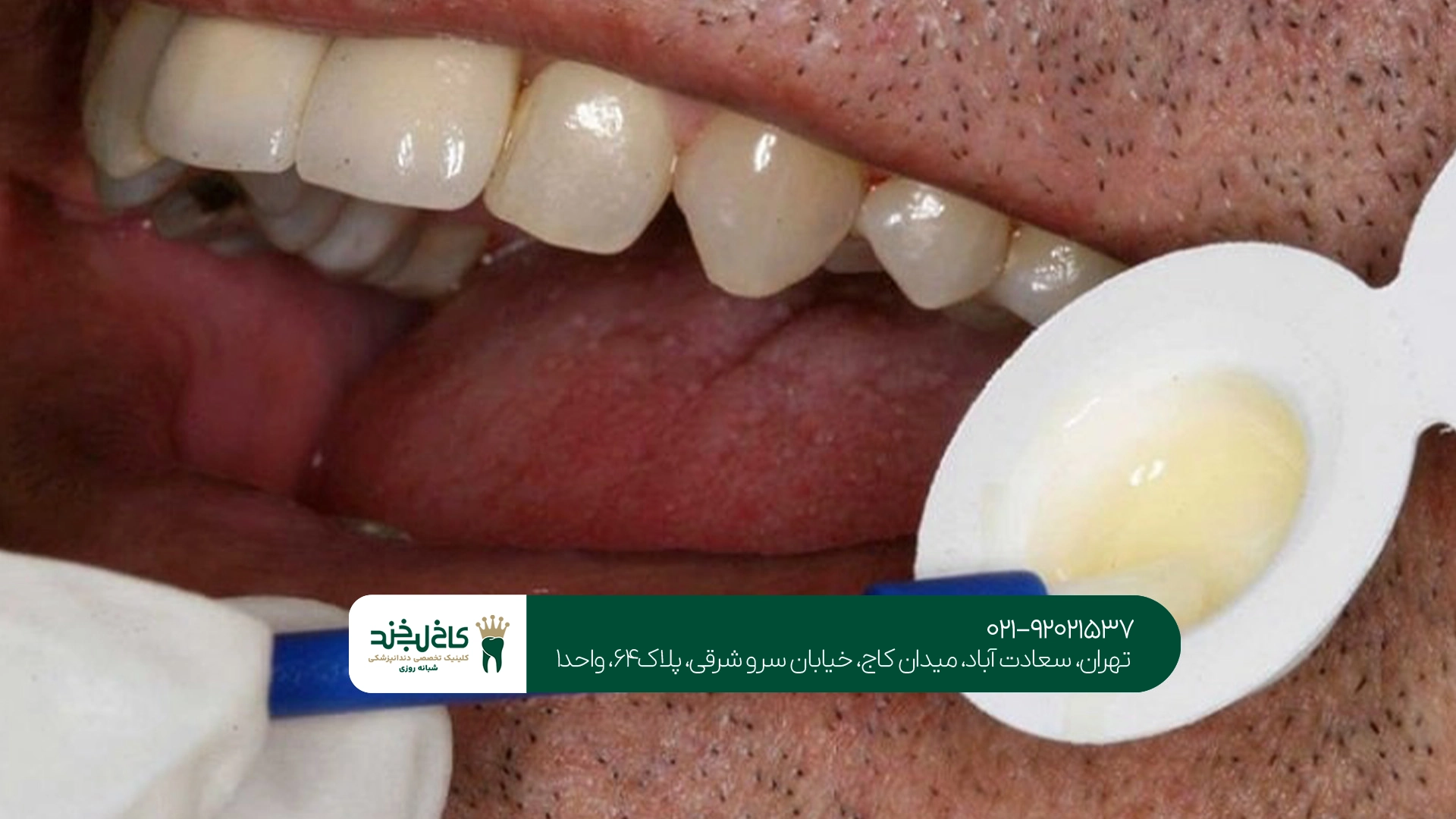 مراقبتهای لازم بعد از انجام فلوراید تراپی مراقبتهای لازم بعد از انجام فلوراید تراپی