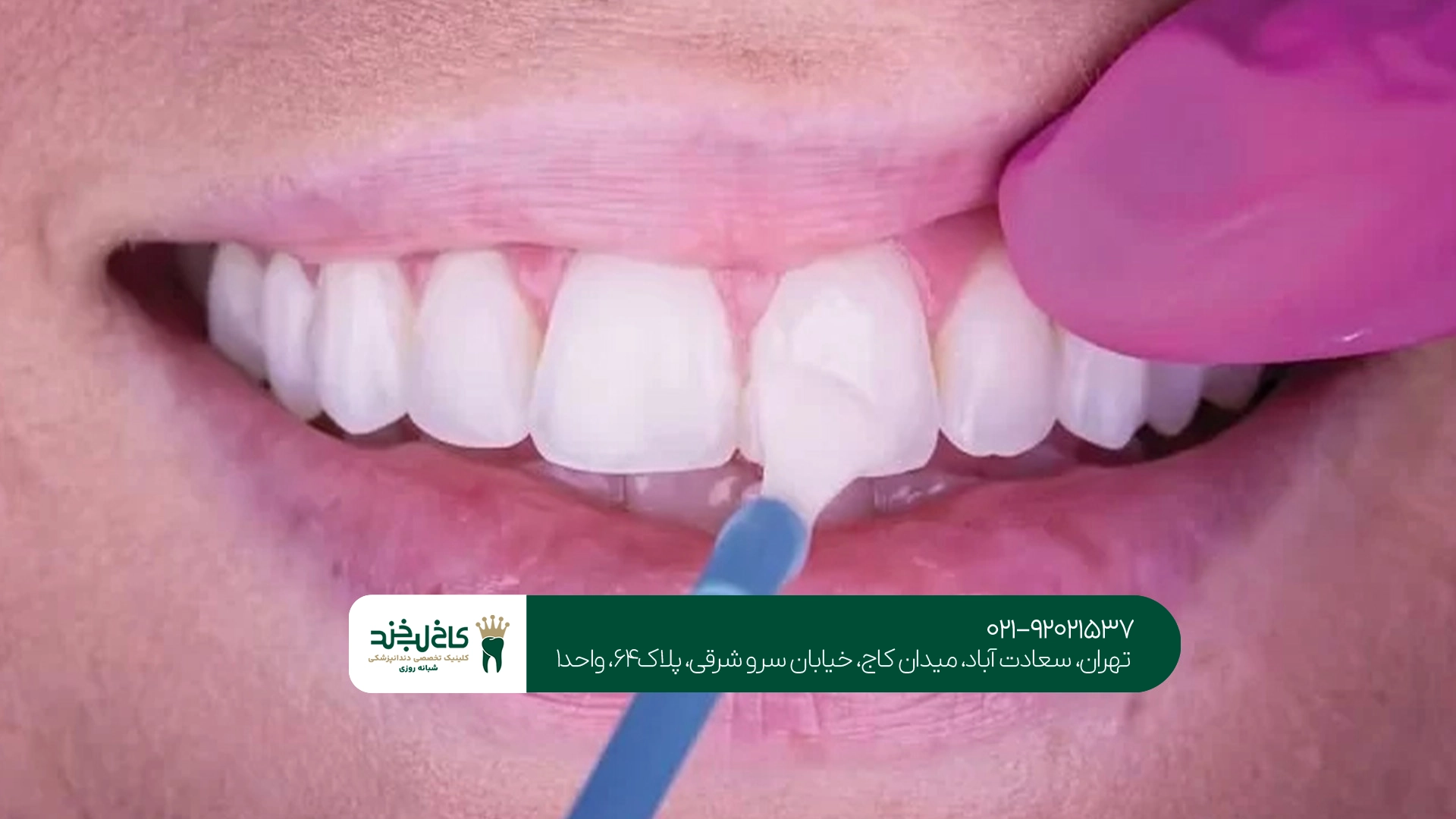 بهترین مرکز فلوراید تراپی بهترین مرکز فلوراید تراپی