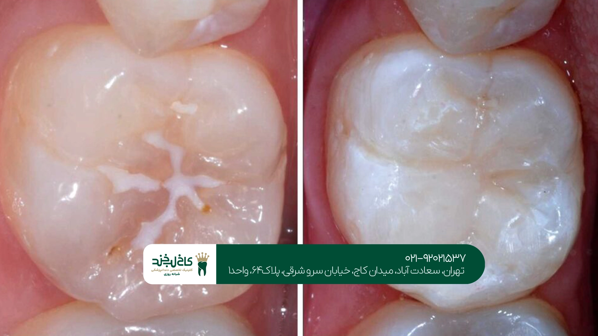 بهترین زمان انجام فیشور سیلانت برای کودکان بهترین زمان انجام فیشور سیلانت برای کودکان