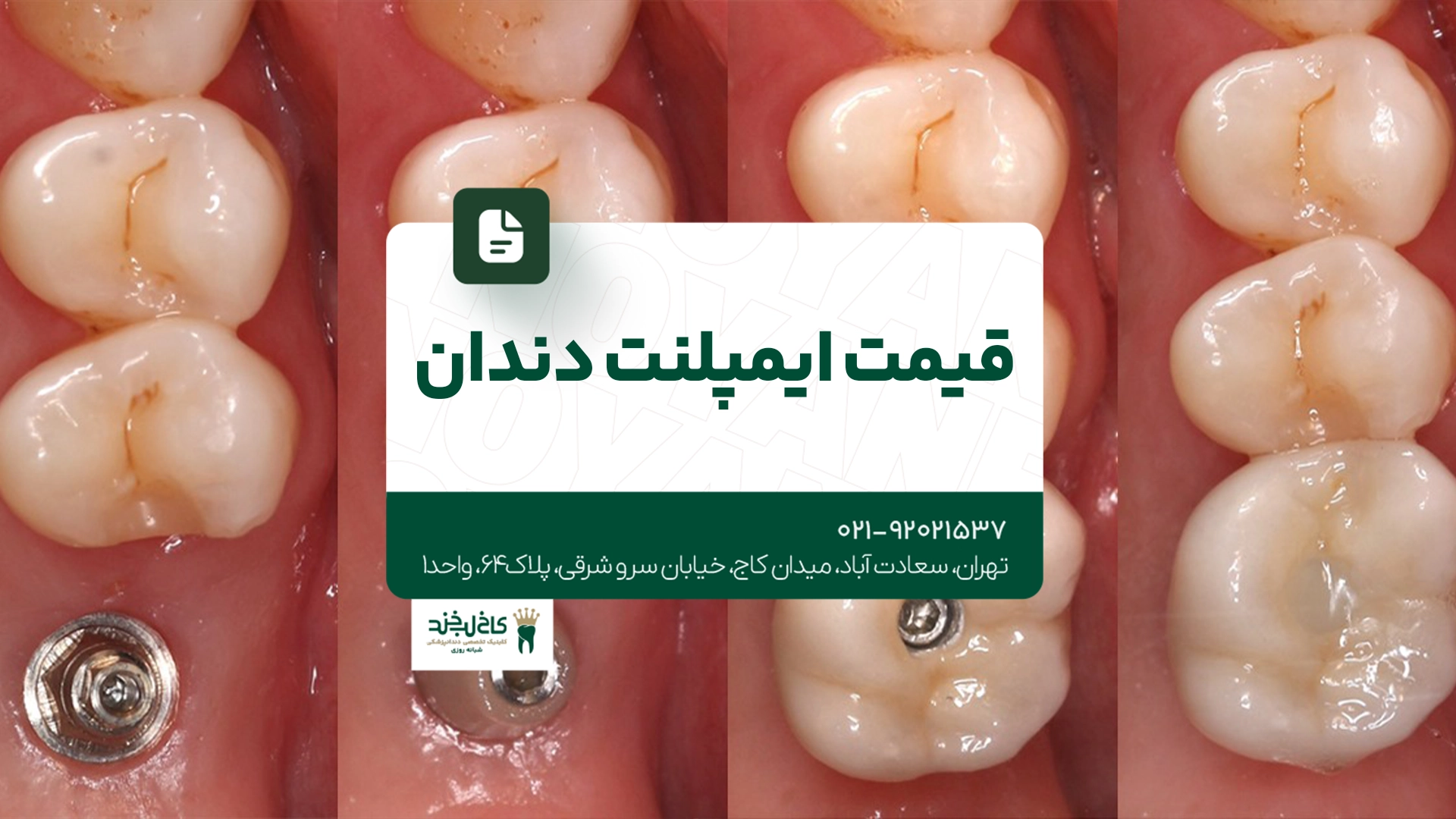 قیمت ایمپلنت دندان