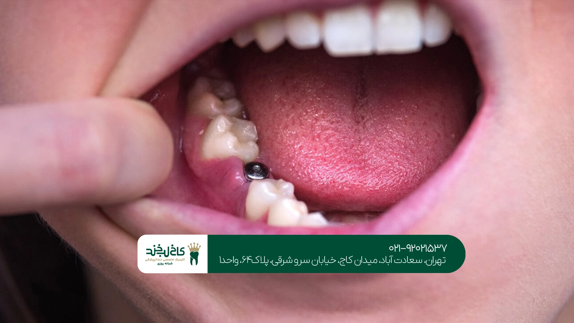 عوامل مؤثر بر قیمت ایمپلنت دندان