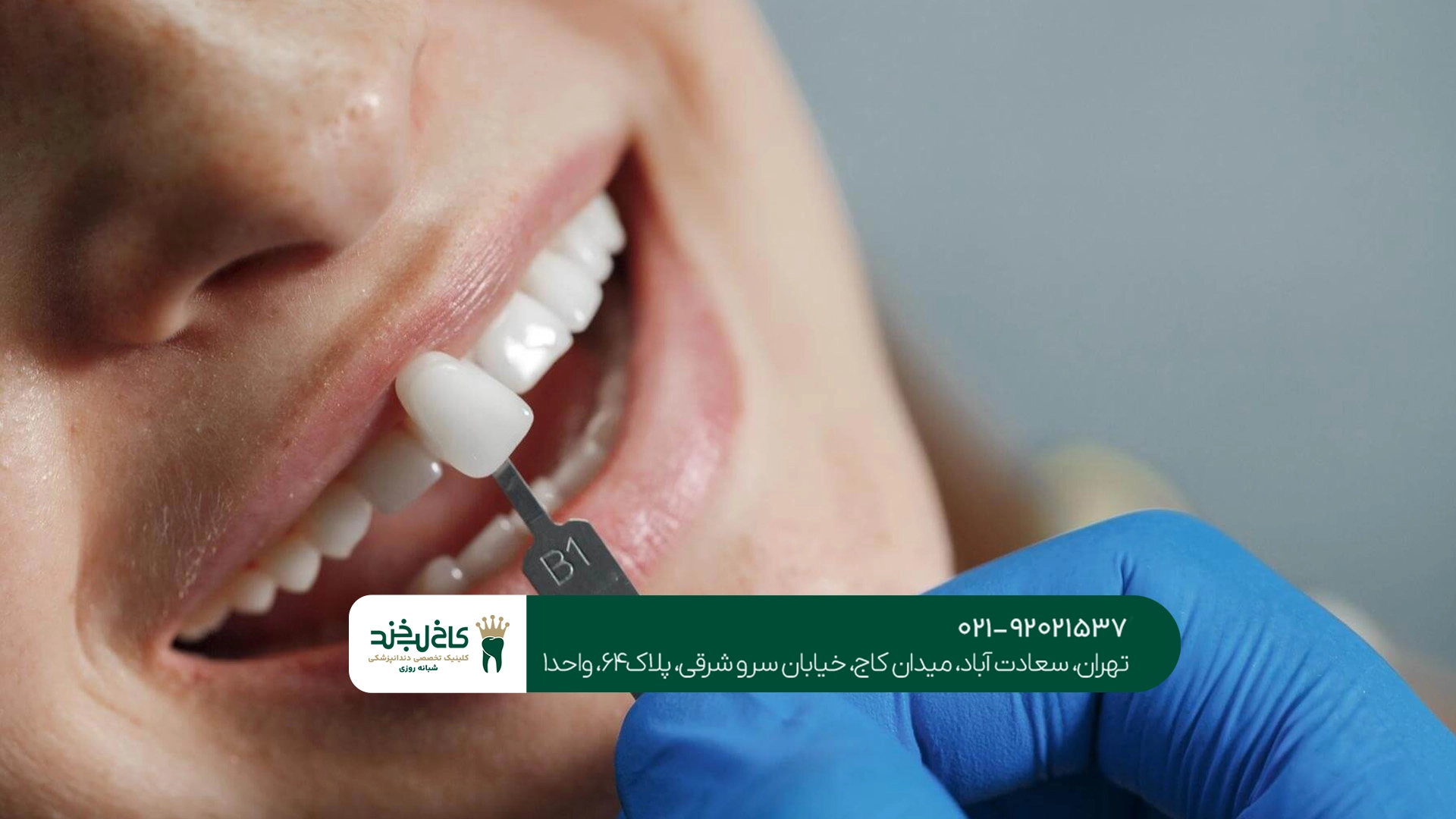 قیمت لمینت دندان چقدر است؟ قیمت لمینت دندان چقدر است؟