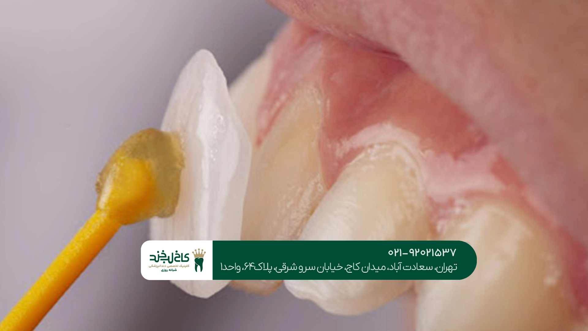 قیمت لمینت دندان برای اصلاح طرح لبخند قیمت لمینت دندان برای اصلاح طرح لبخند