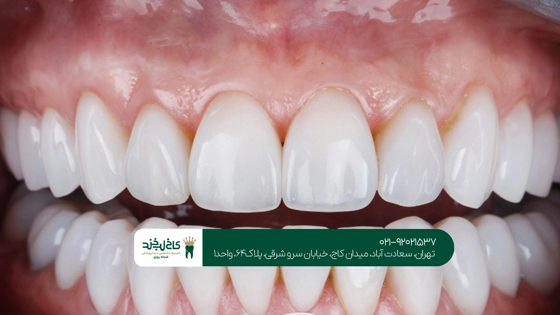 پرداخت اقساطی لمینت دندان پرداخت اقساطی لمینت دندان