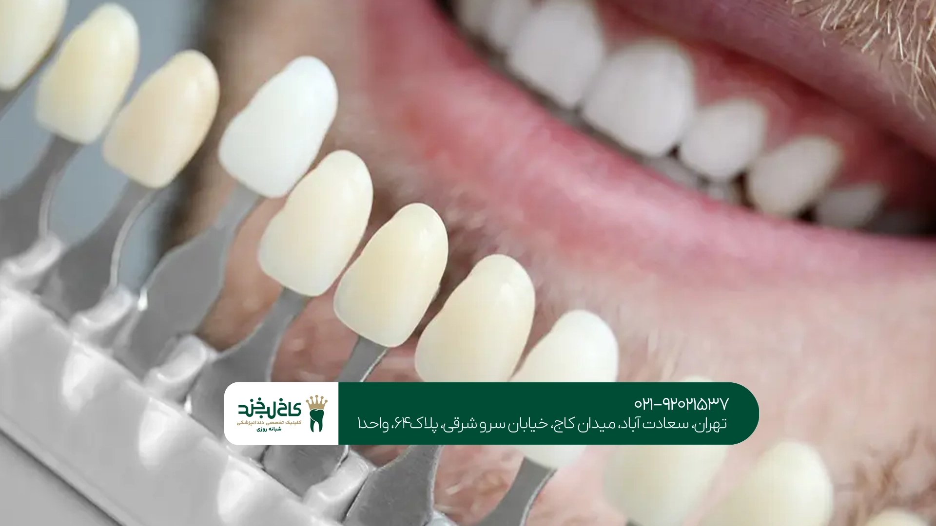 مرکز حرفهای لمینت دندان