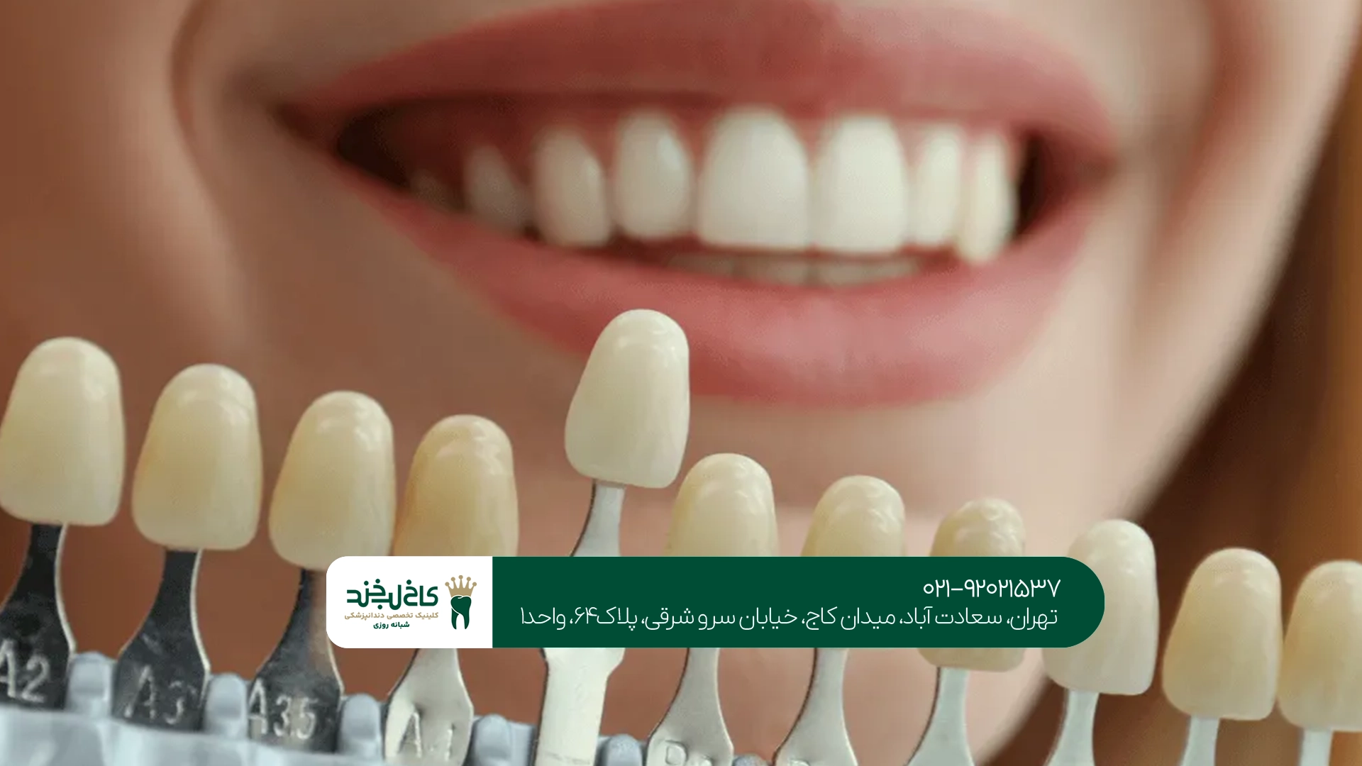 بهترین کلینیک لمینت اقساطی