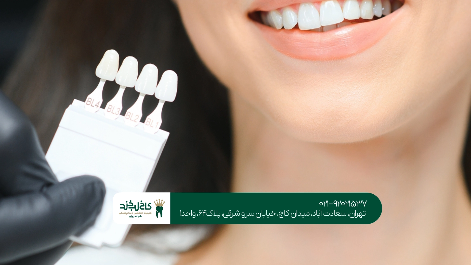 لمینت اقساطی برای چه افرادی مناسب است؟