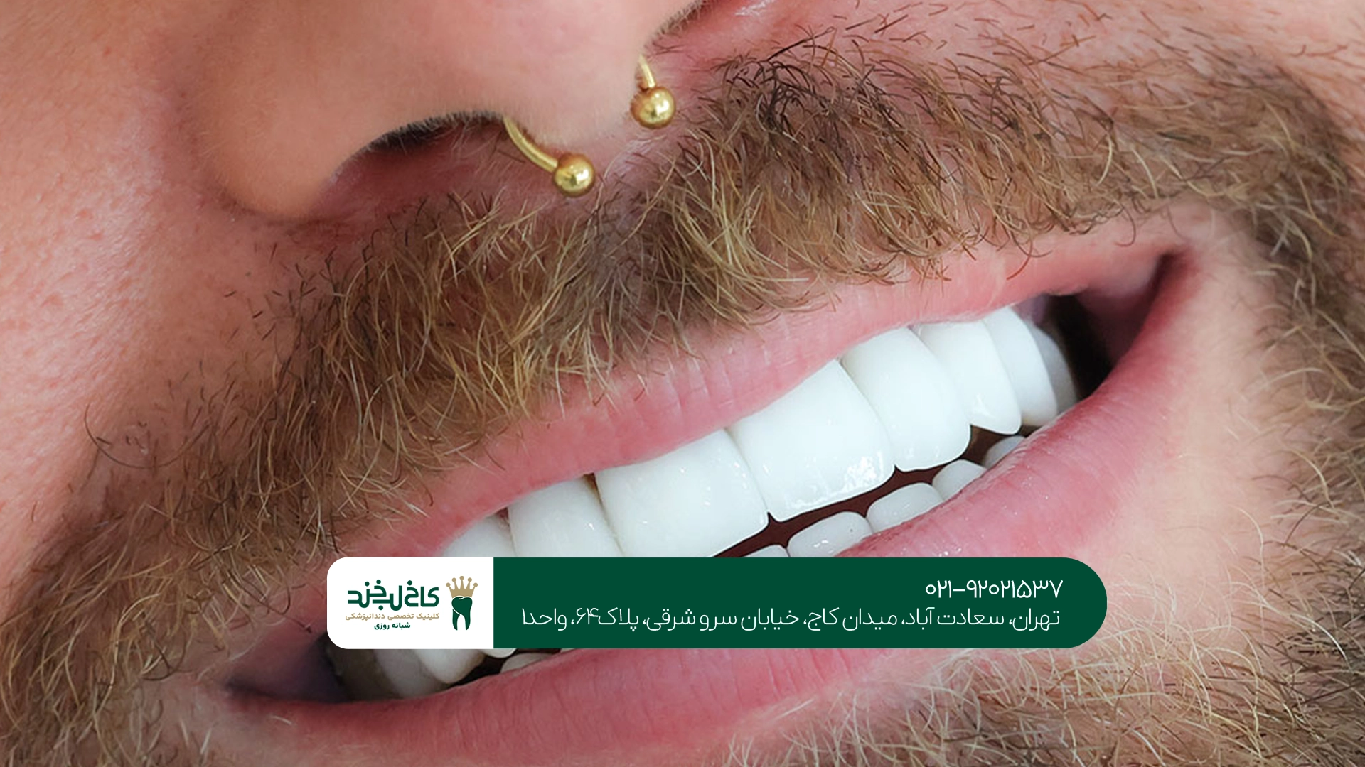 لمینت دندان برای چه افرادی مناسب است؟