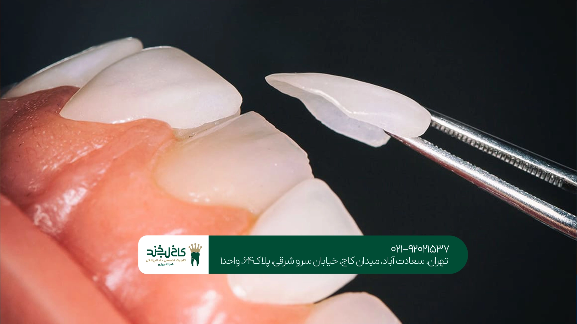 لمینت دندان اقساطی تهران