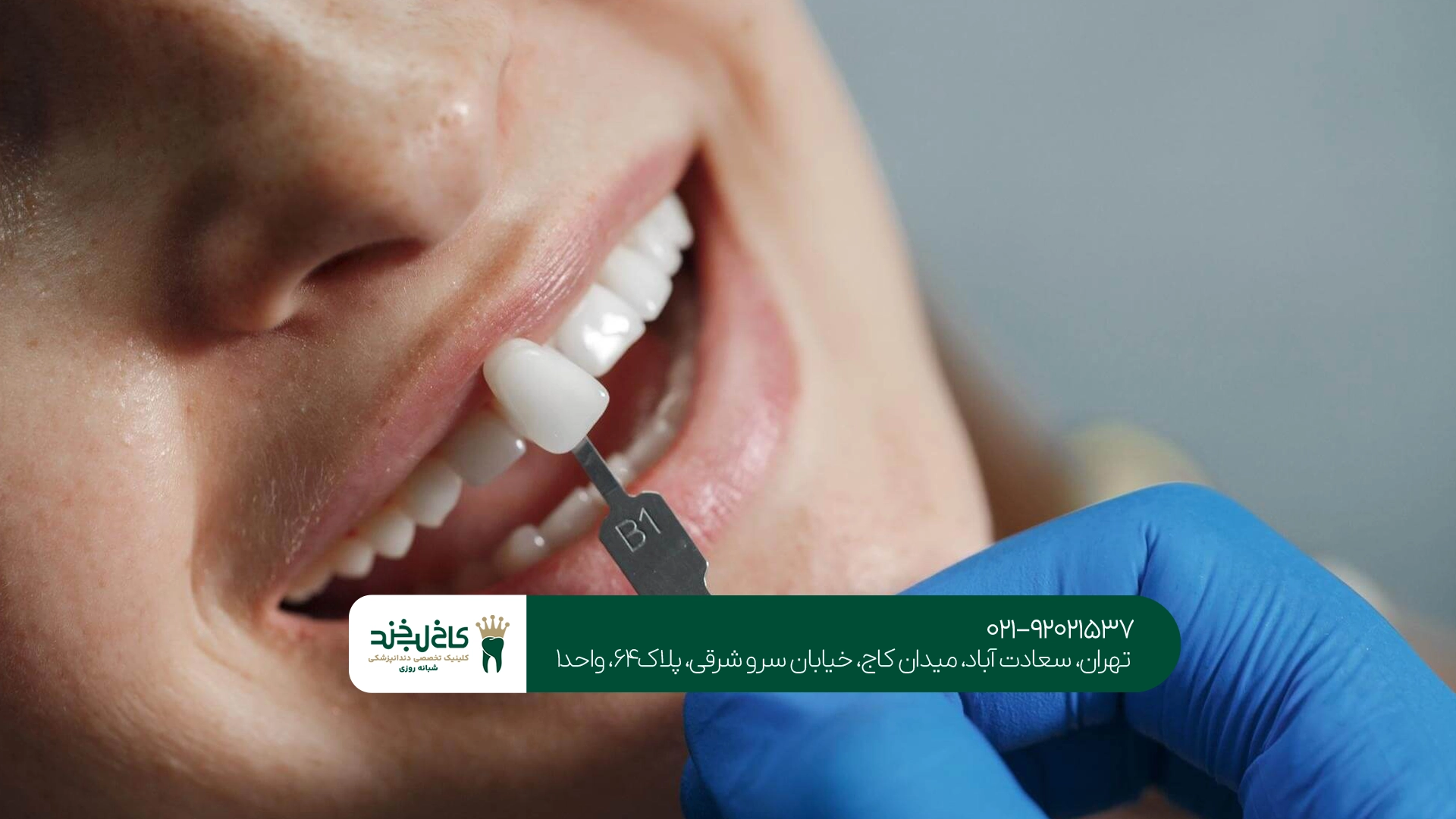 لمینت دندان دیجیتال تهران