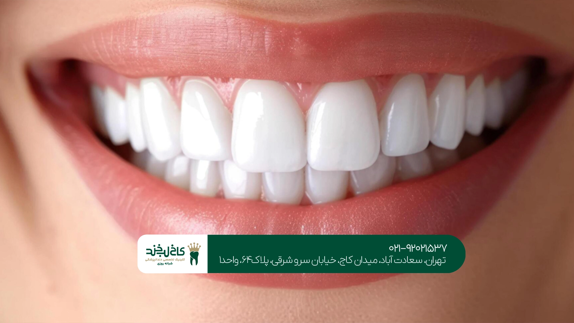 بهترین کلینیک لمینت دندان سعادت آباد بهترین کلینیک لمینت دندان سعادت آباد
