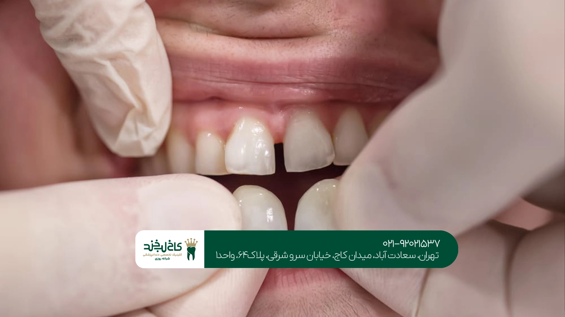 لمینت دندان در سعادت آباد لمینت دندان در سعادت آباد