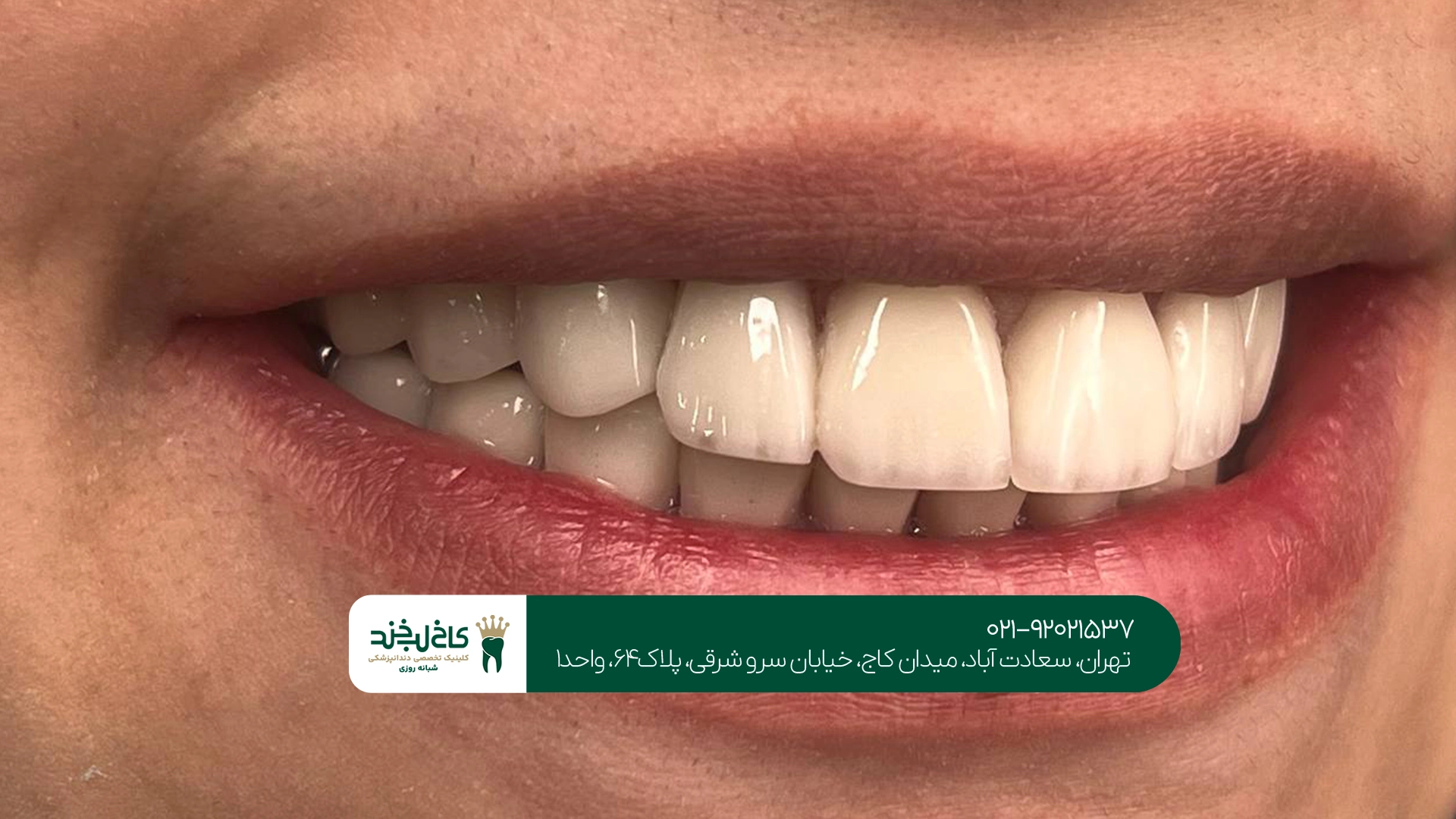 مرکز تخصصی لمینت زیرکونیا