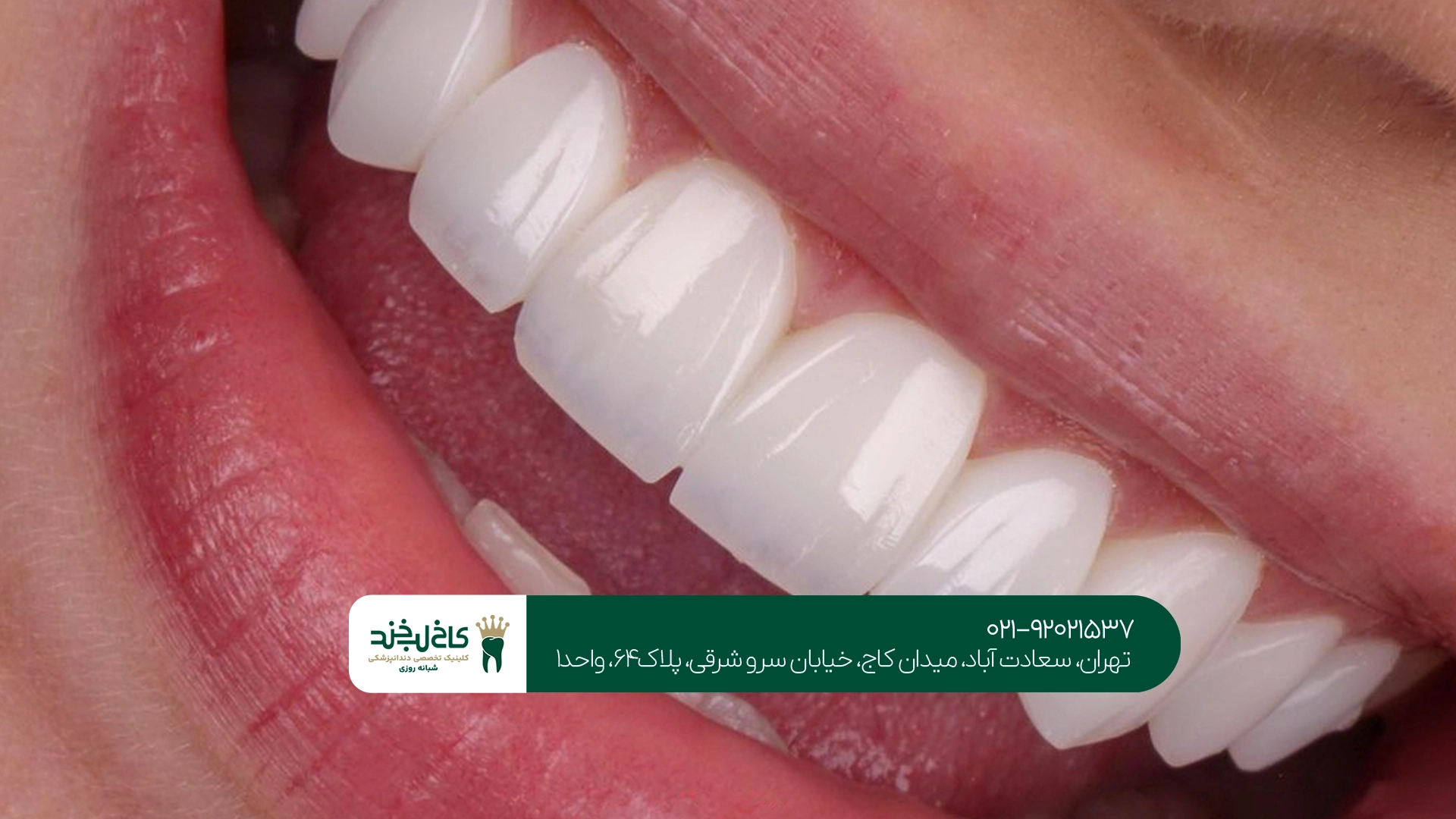 لمینت زیرکونیا چه مزایا و معایبی دارد؟