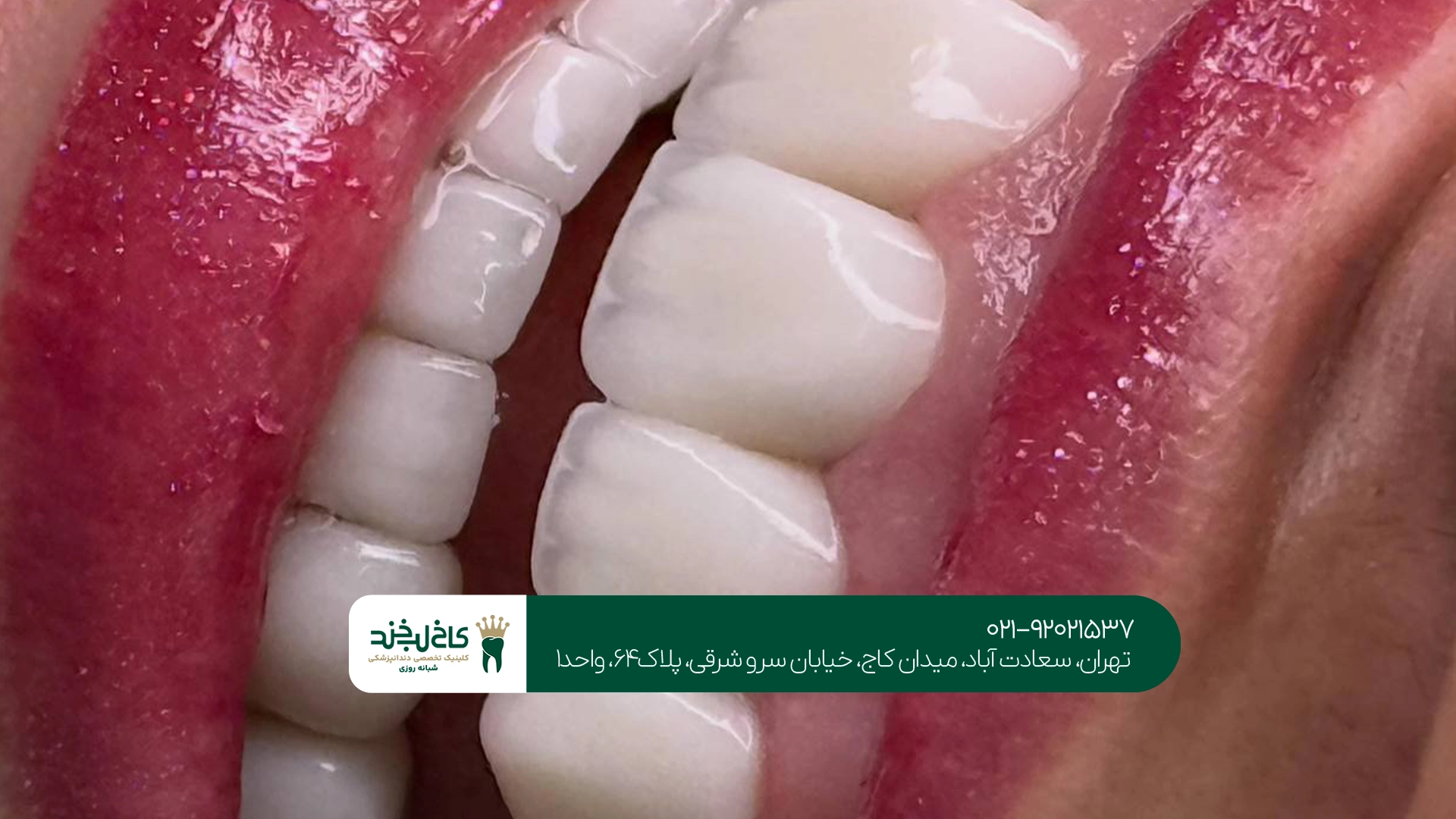 لمینت زیرکونیا چقدر دوام و ماندگاری دارد؟