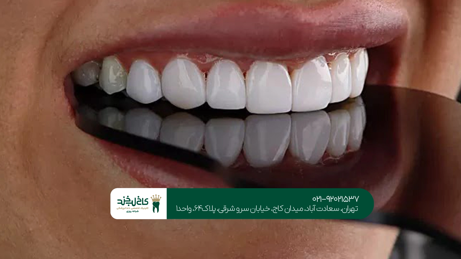 لمینت دندان طبیعی