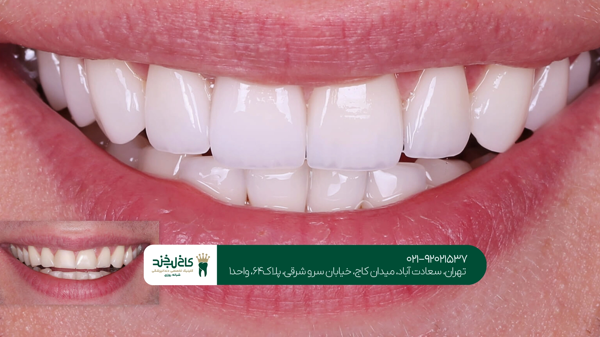 لمینت سرامیکی تهران