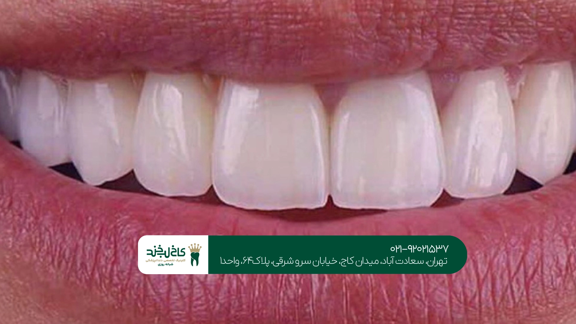 لمینت سرامیکی برای چه افرادی مناسب است؟