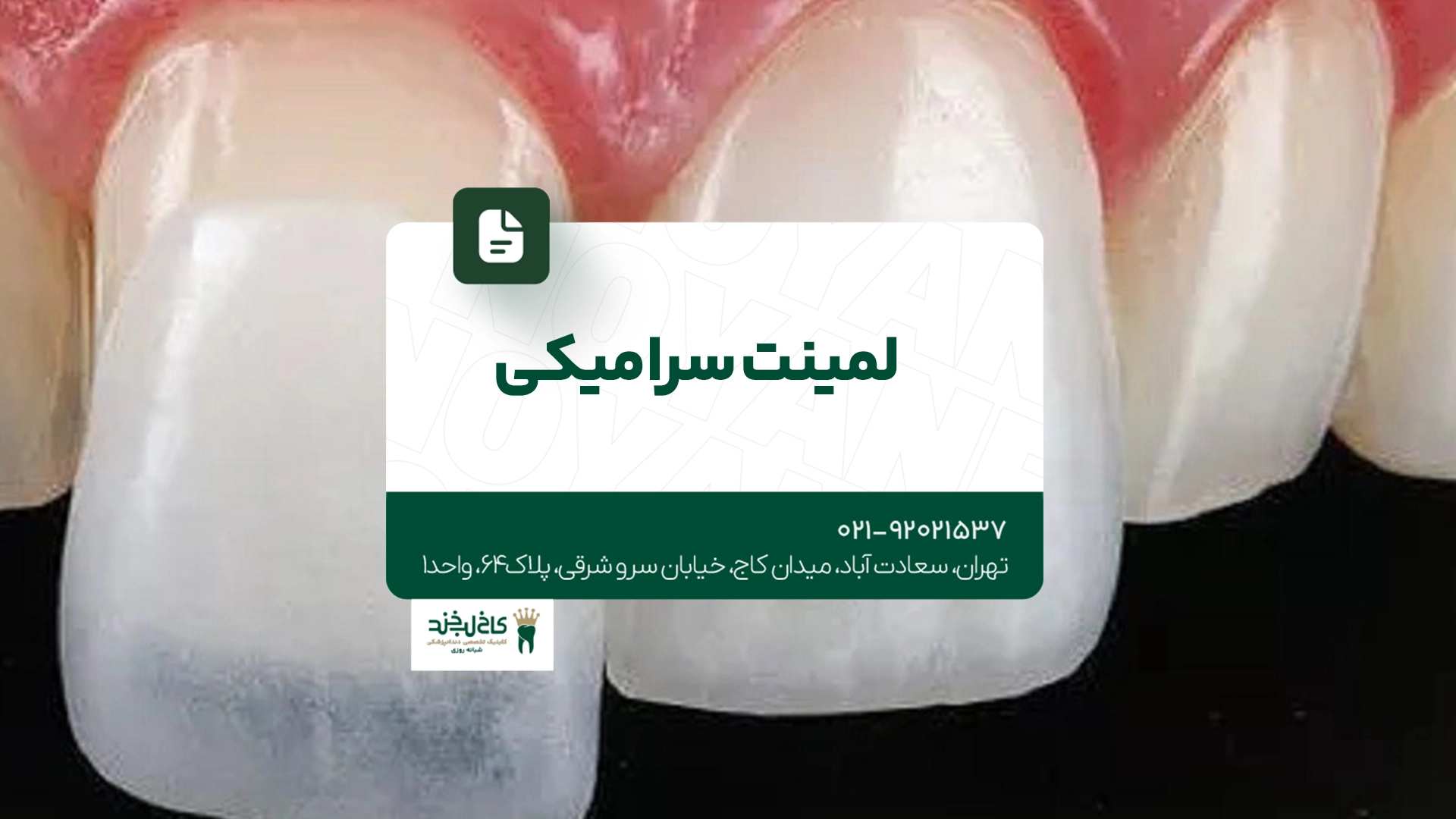لمینت سرامیکی