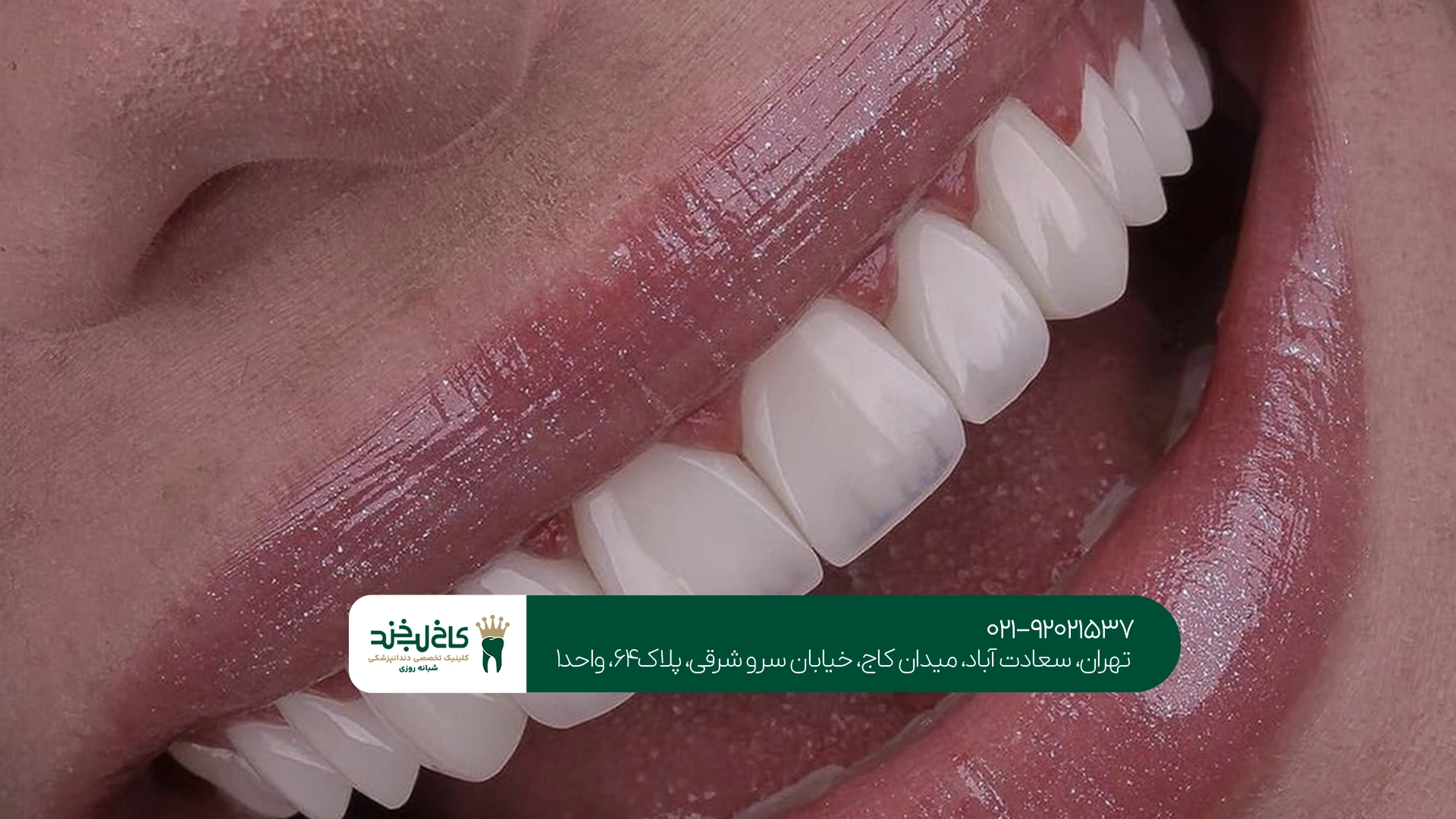 کلینیک لمینت فوق نازک تهران