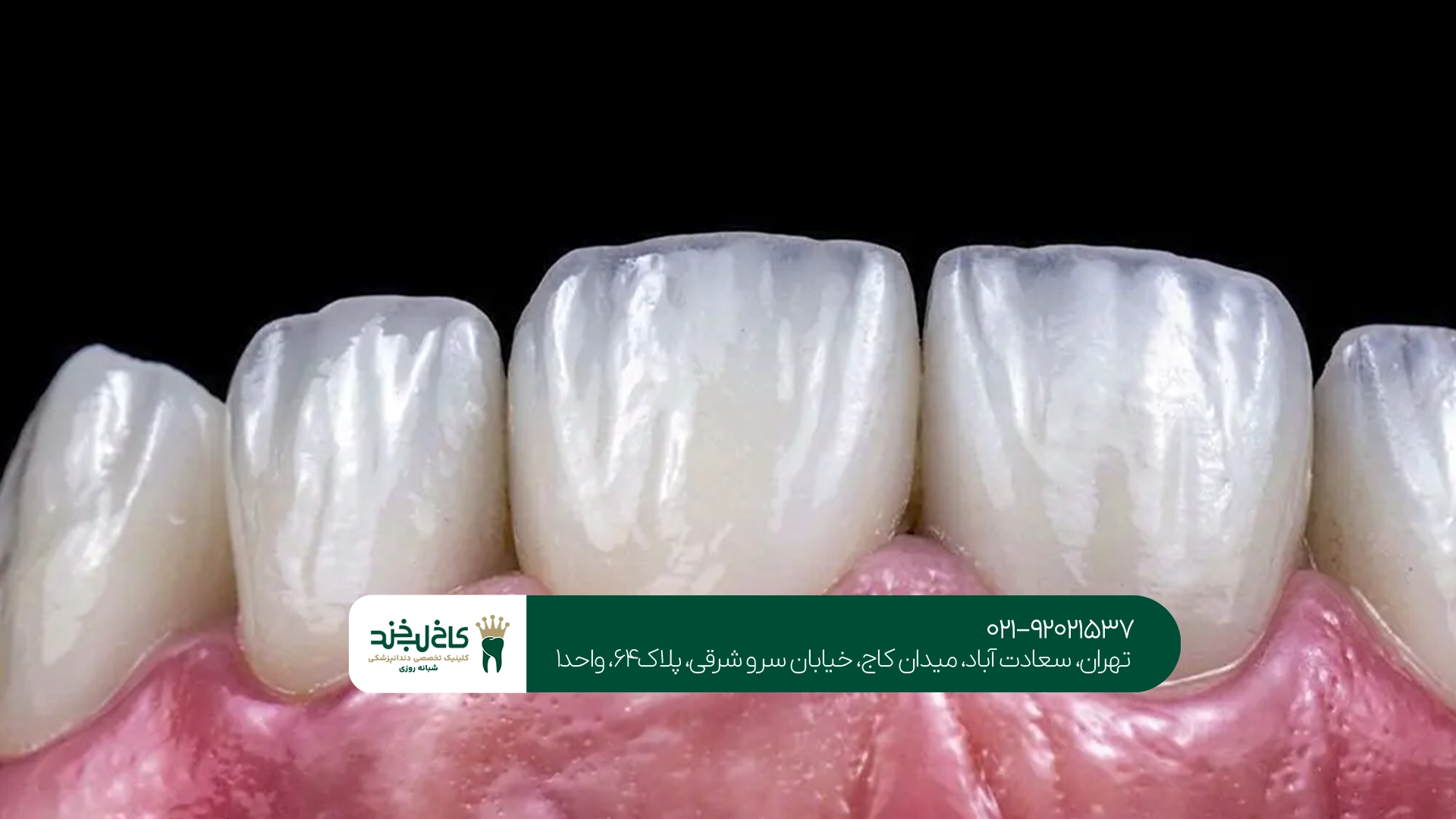 هزینه لمینت فوق نازک دندان به چه عواملی بستگی دارد؟